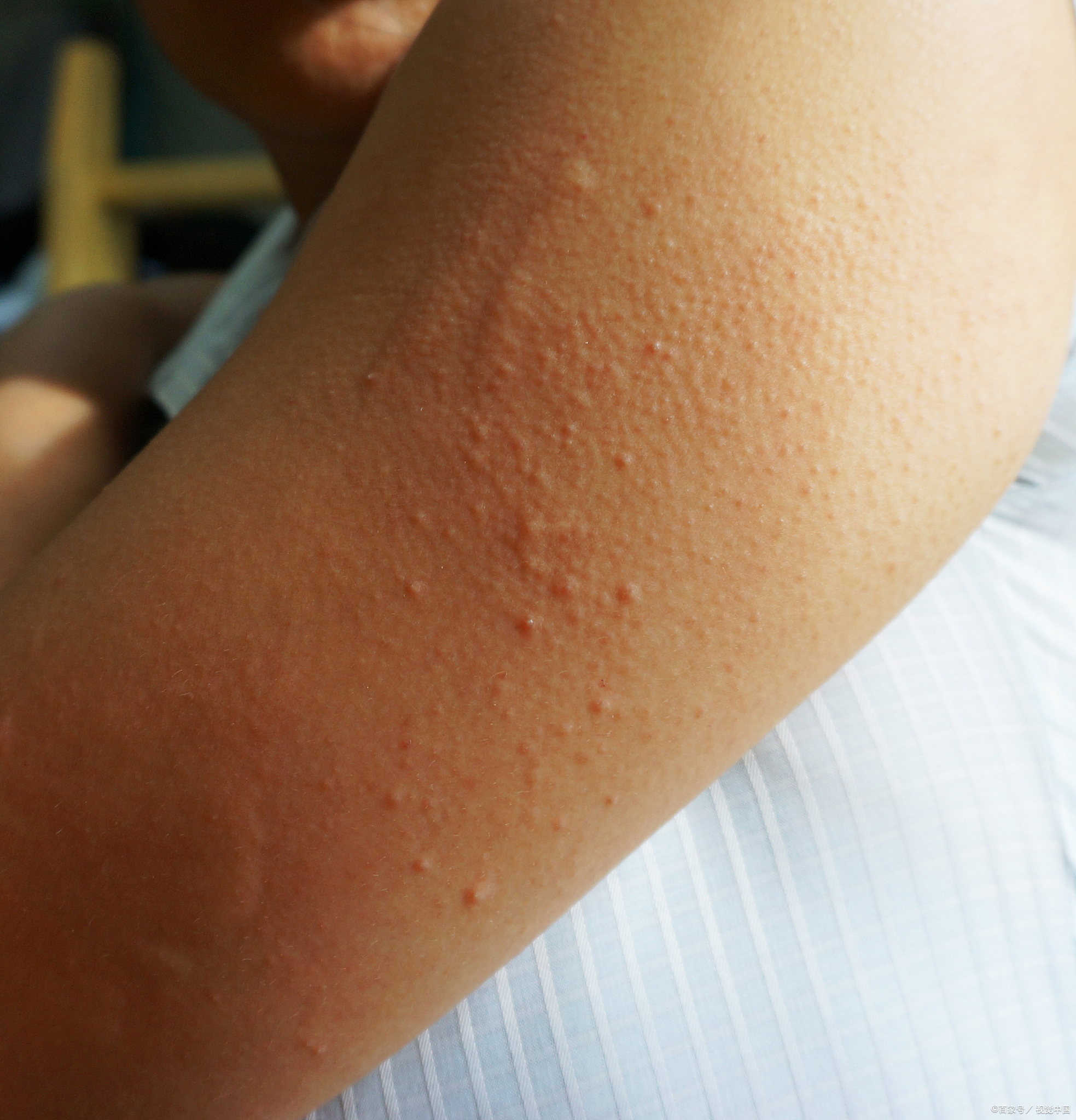 三招识别手足口病