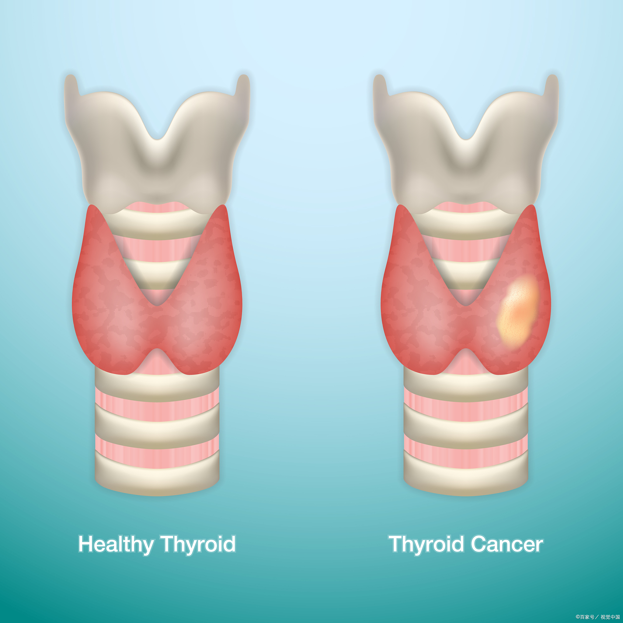 我被诊断出甲状腺癌,整个人都陷入了恐惧和迷茫.