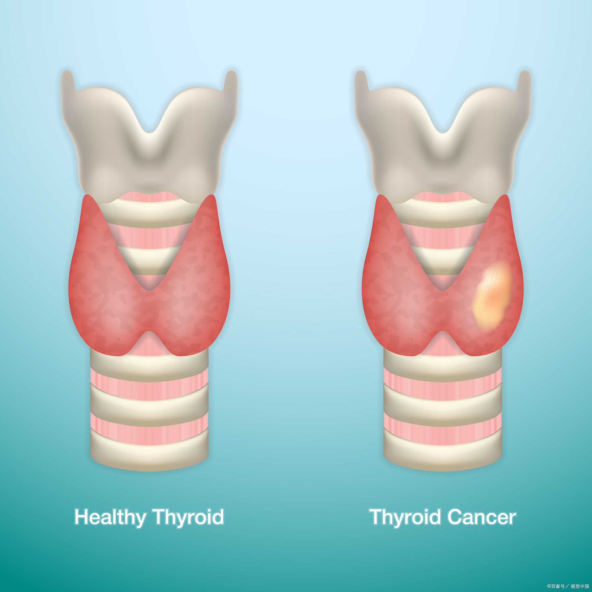 为什么会得甲状腺癌图片