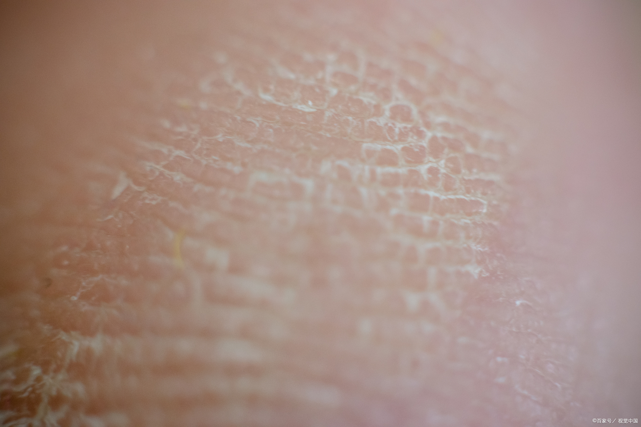 热点周际赛# 1月18日湖北, 三岁宝宝身体太干全身起皮,妈妈表示:"从