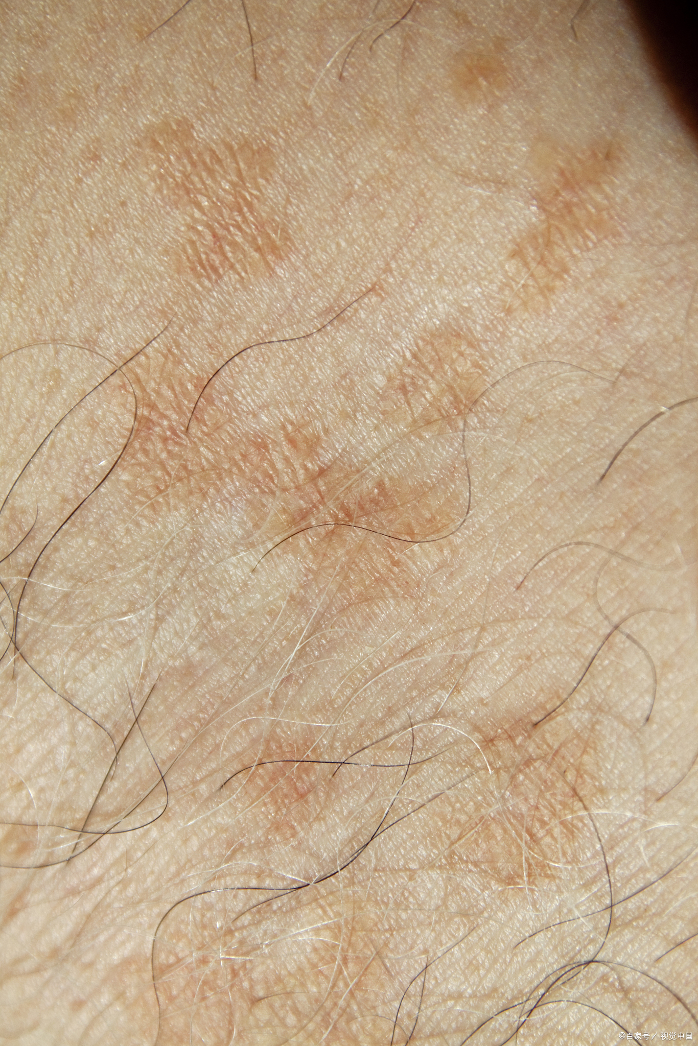 1,皮肤干燥:环境干燥,过度清洁或使用刺激性洗浴产品会导致皮肤水分