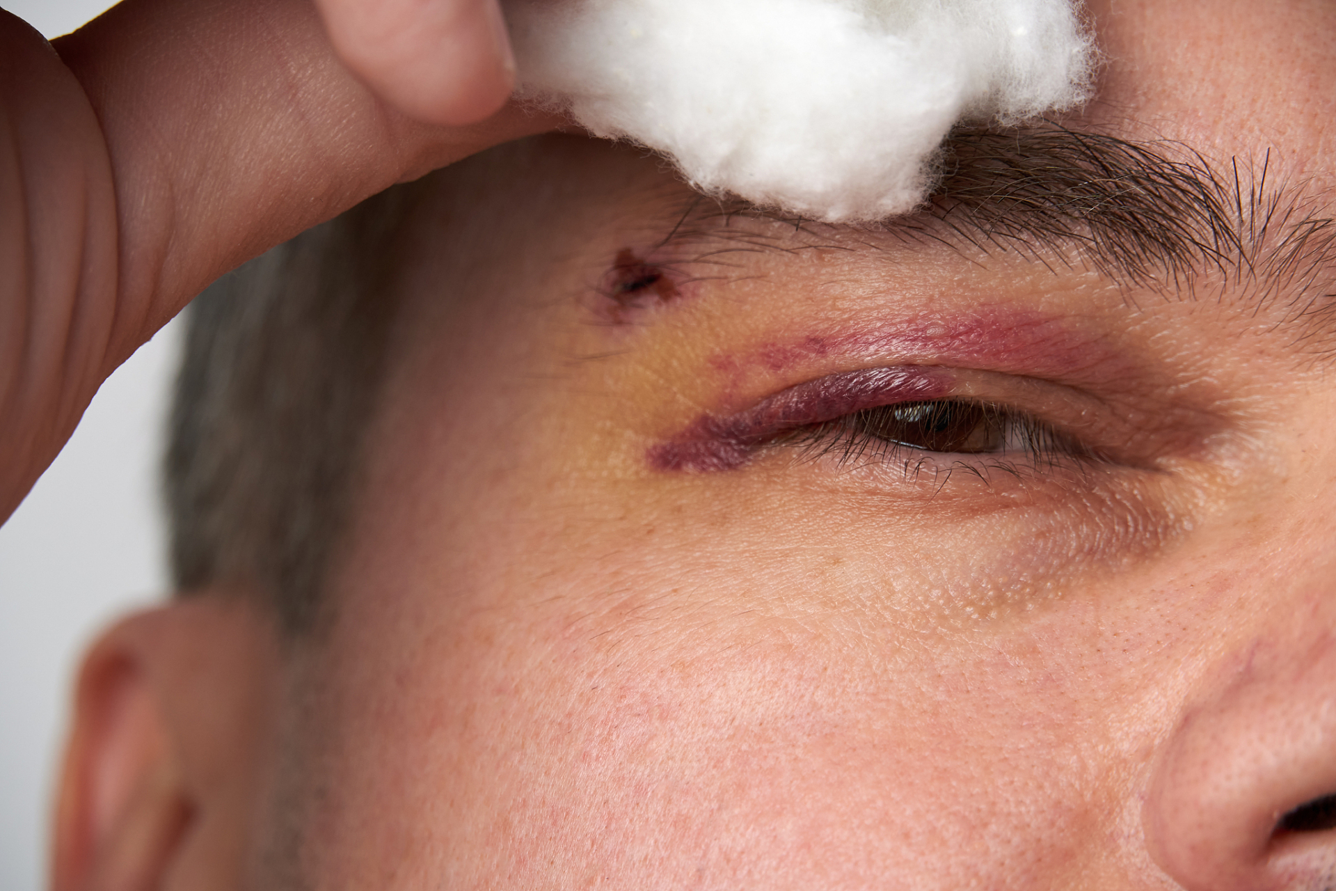 正确方法是用无菌纱布或者干净的毛巾覆盖在眼睛上,双眼闭合,立即到