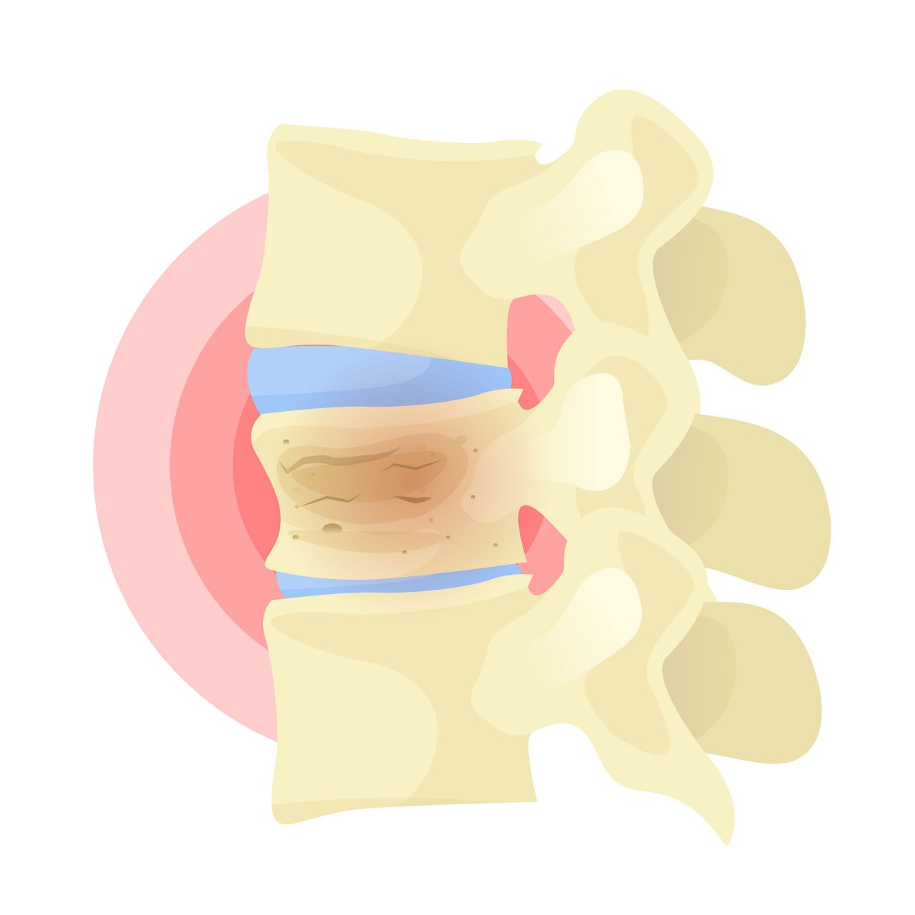认清骨关节炎与损伤,帮你保养关节避免疼痛.