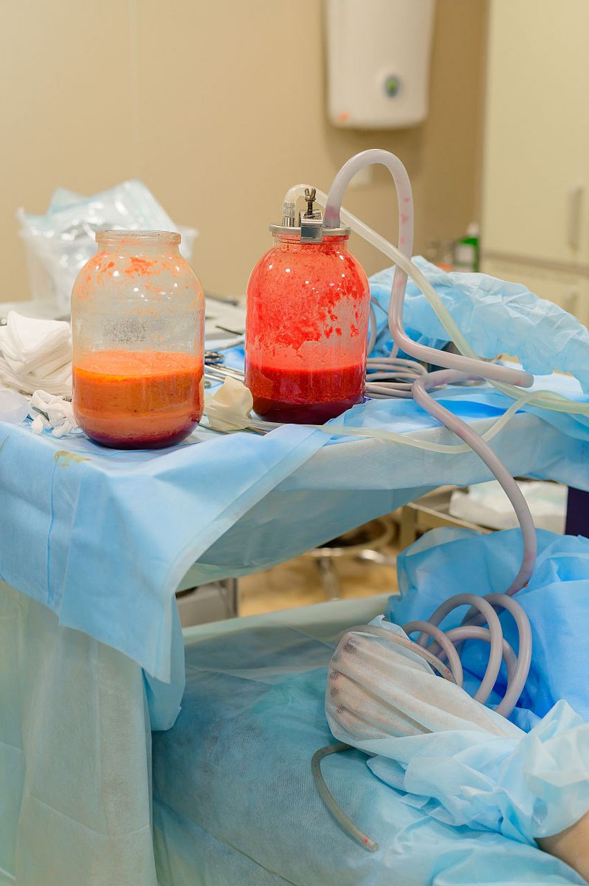 吸脂手术中5000cc算多吗?