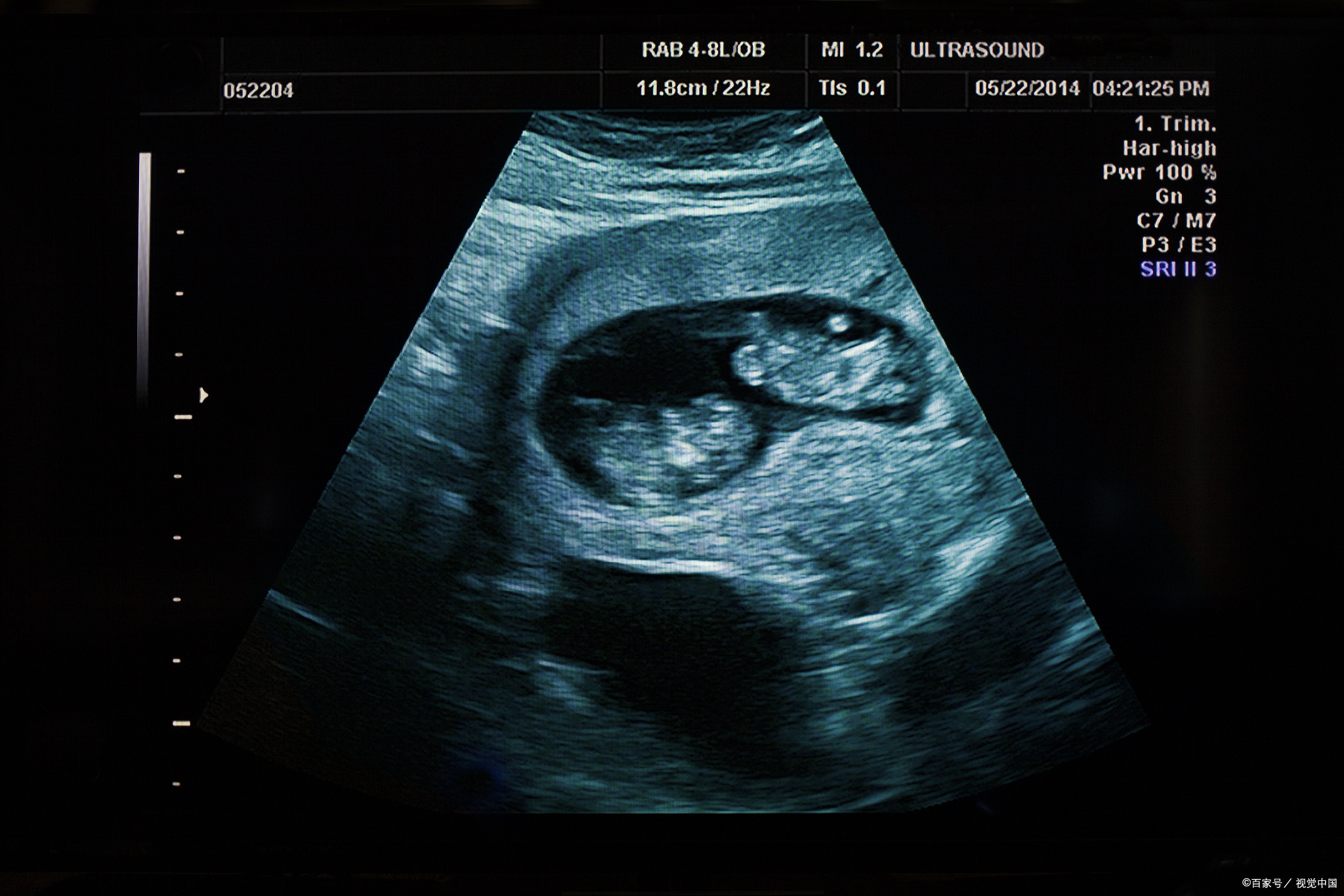 男性也需要做乳腺超声检查吗?