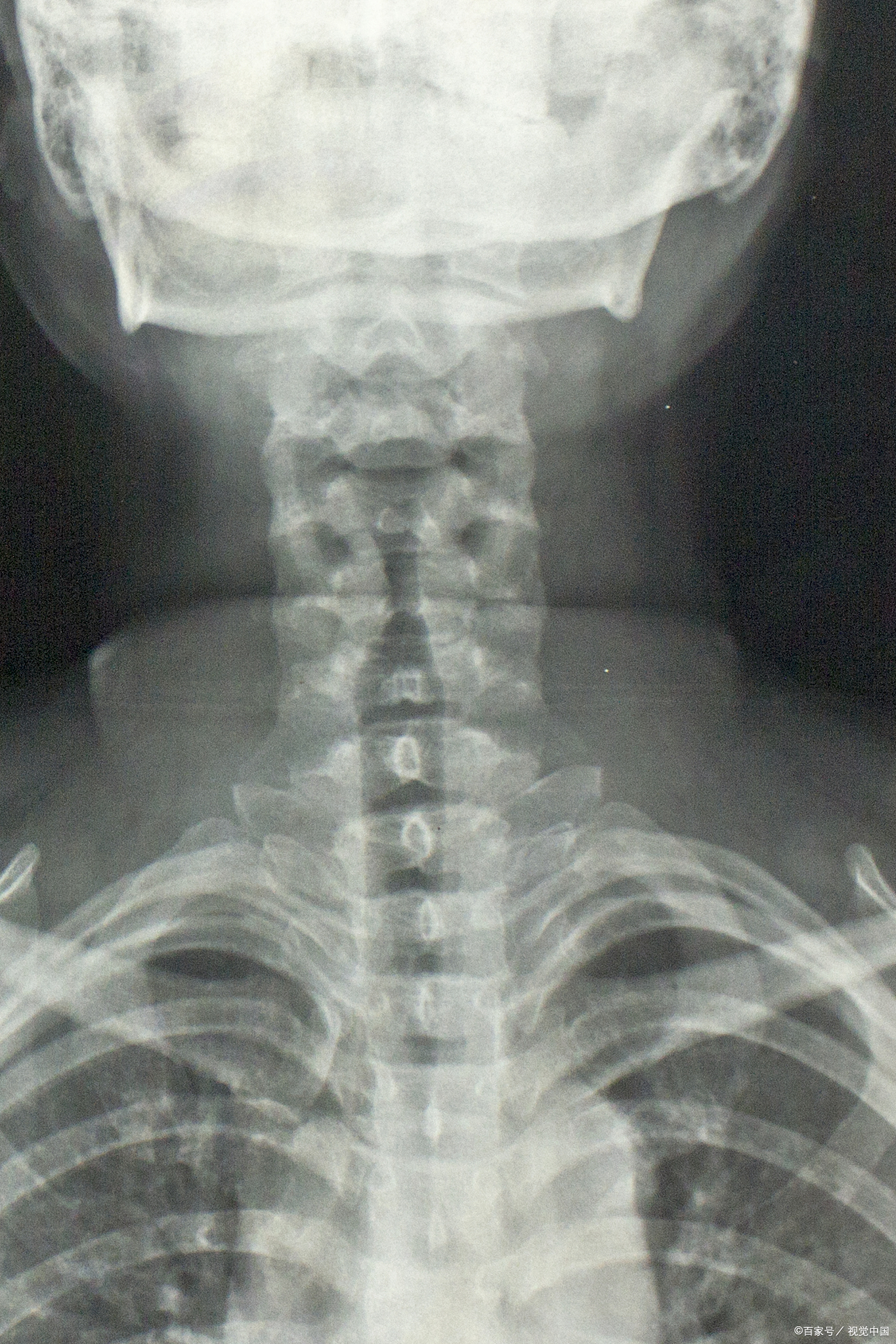 颈椎神经根袖囊肿,怎么办?  前段时间,我接诊了一位名叫李女士的患者.