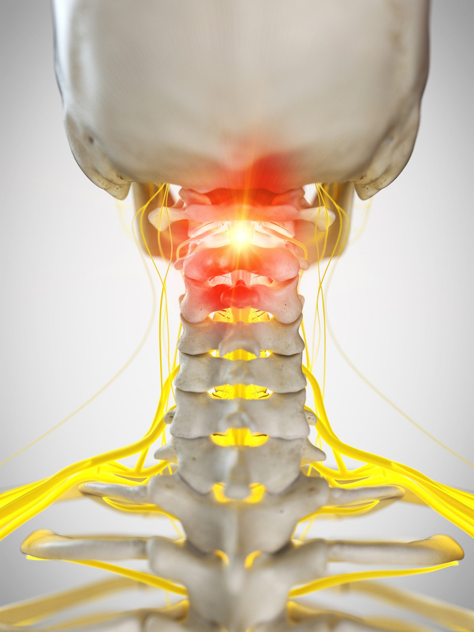 颈椎病手术一般是安全有效的,但像任何手术一样,它也存在一些风险.