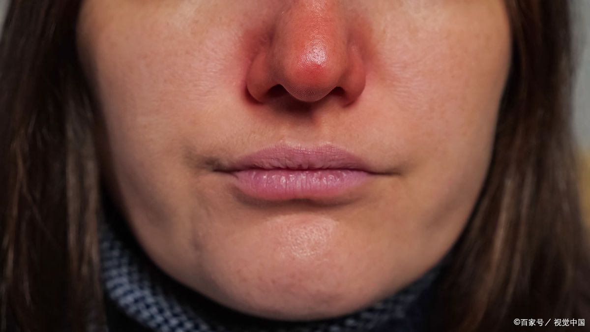 鼻翼红肿疼痛怎么回事?