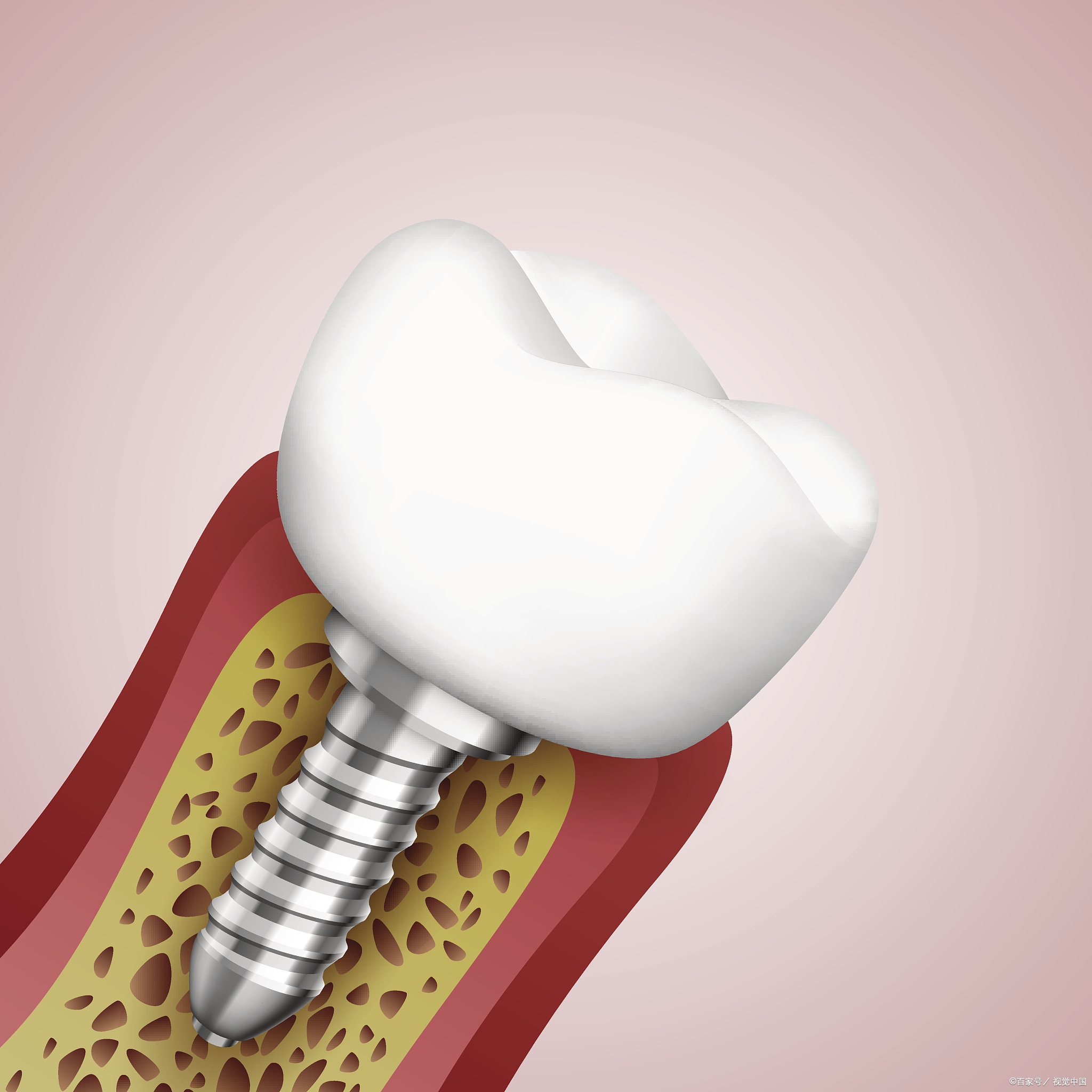 种植牙人工牙根图片图片