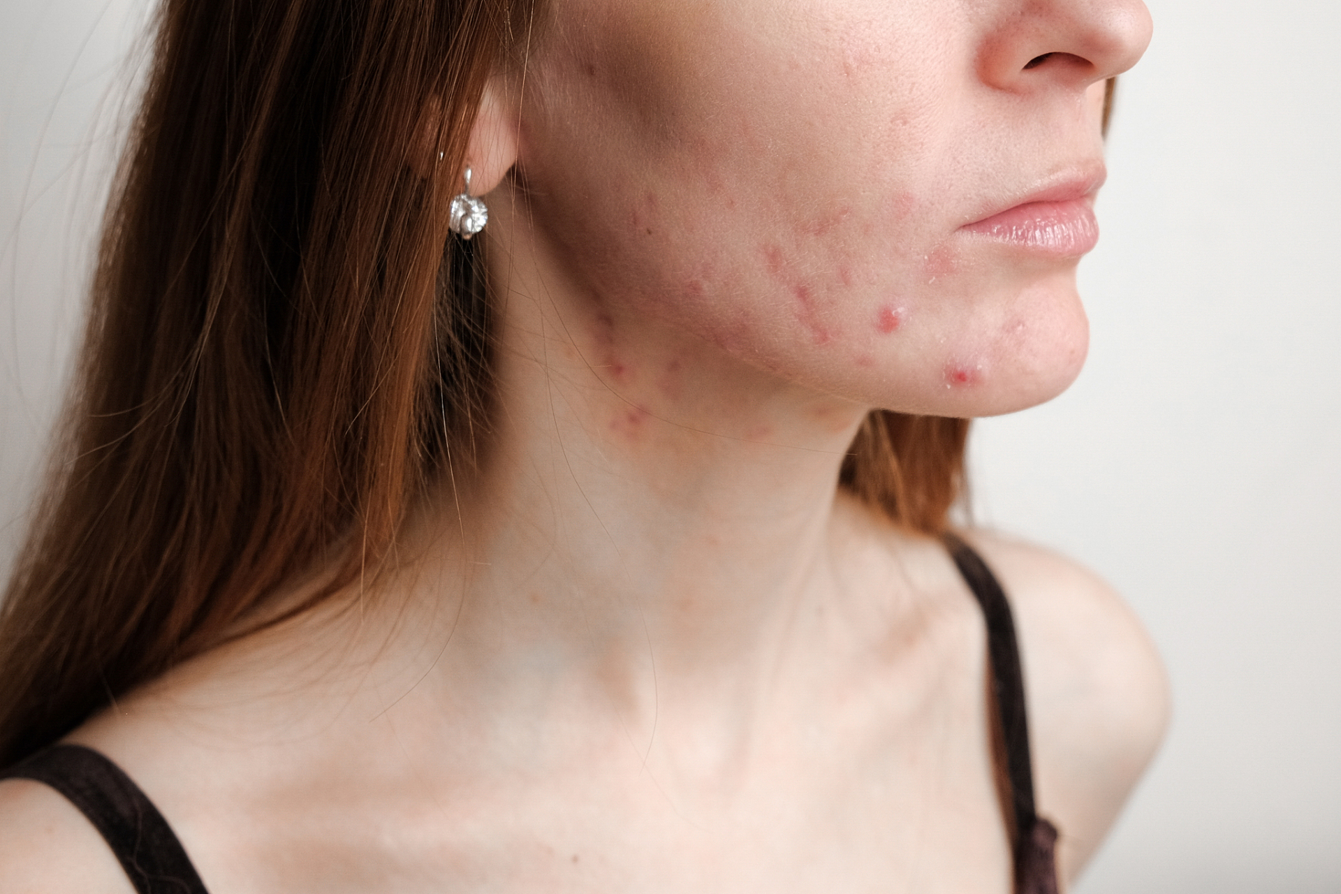 女性下巴频繁长痘痘用什么药 #红蓝光祛痘#   面部痘痘是许多人都会