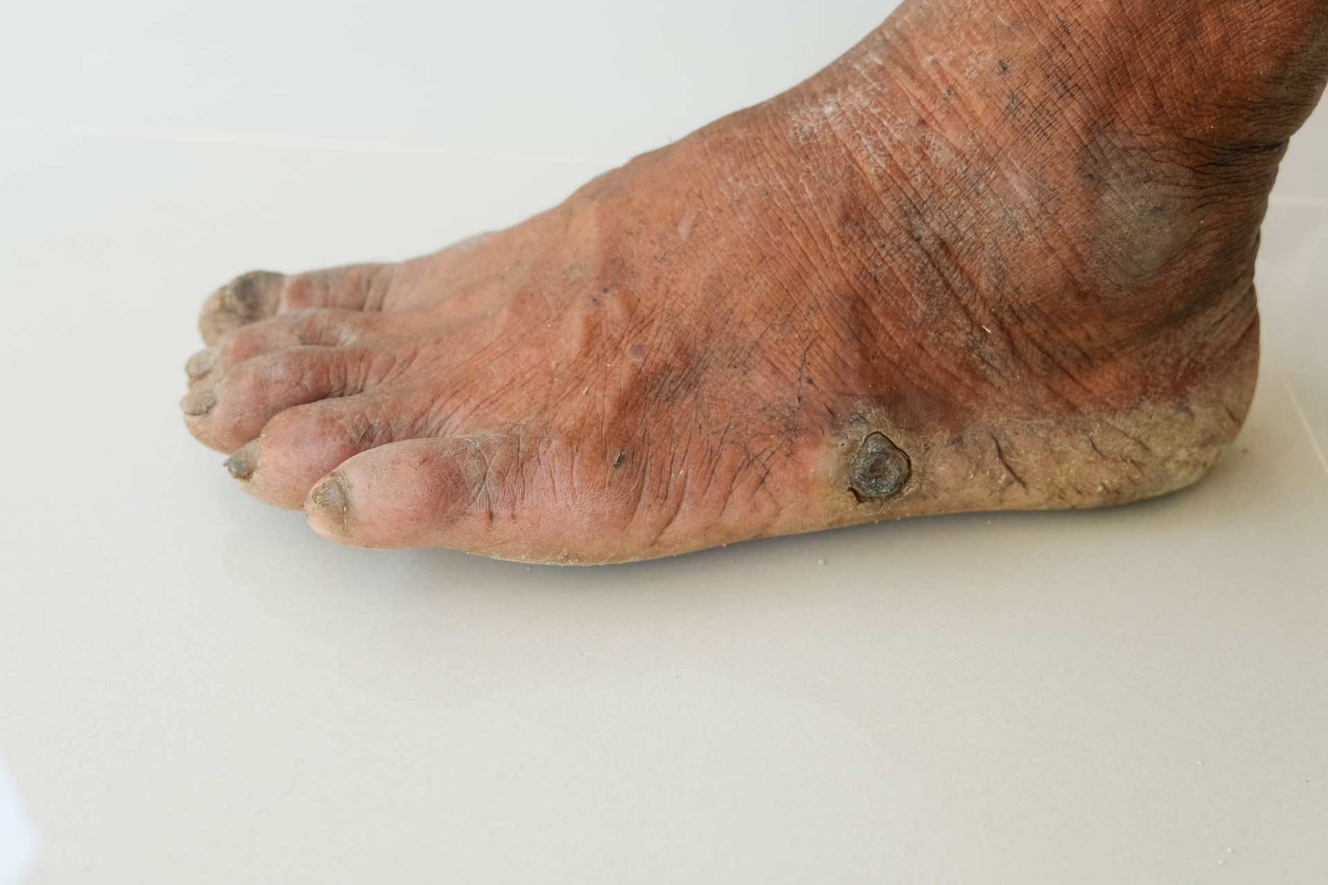 糖尿病足病是指,糖尿病患者因神经病变及各种不同程度末梢血管病变而