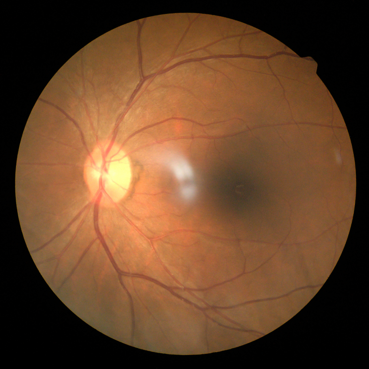 作为一个四十多年经验的老中医,我想和大家聊聊糖尿病视网膜病变这事