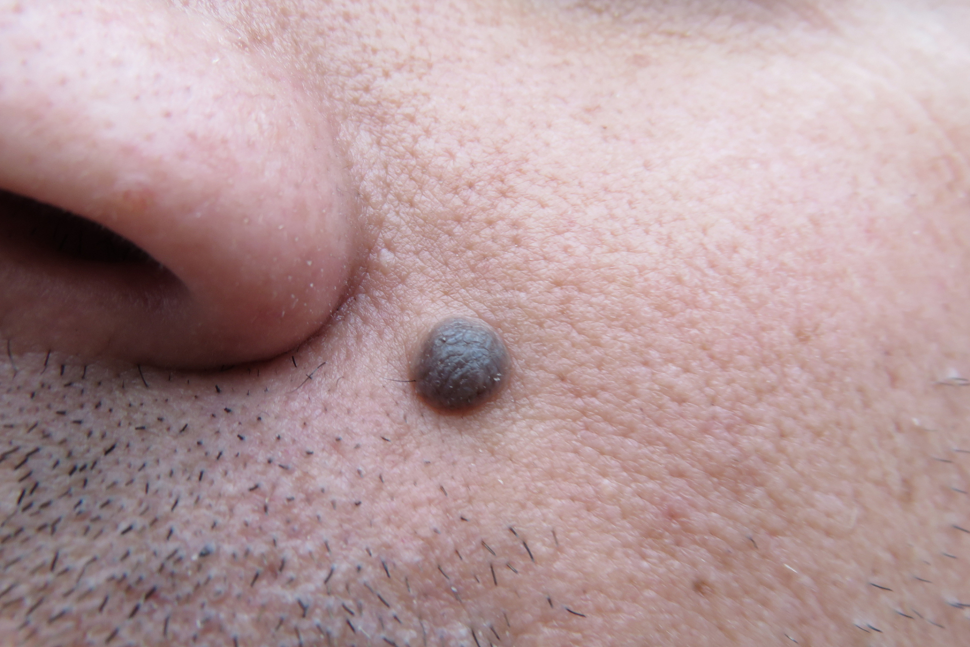 1,如果一个痣外观上是圆形或椭圆形,可能是良性,如果出现不对称,可能