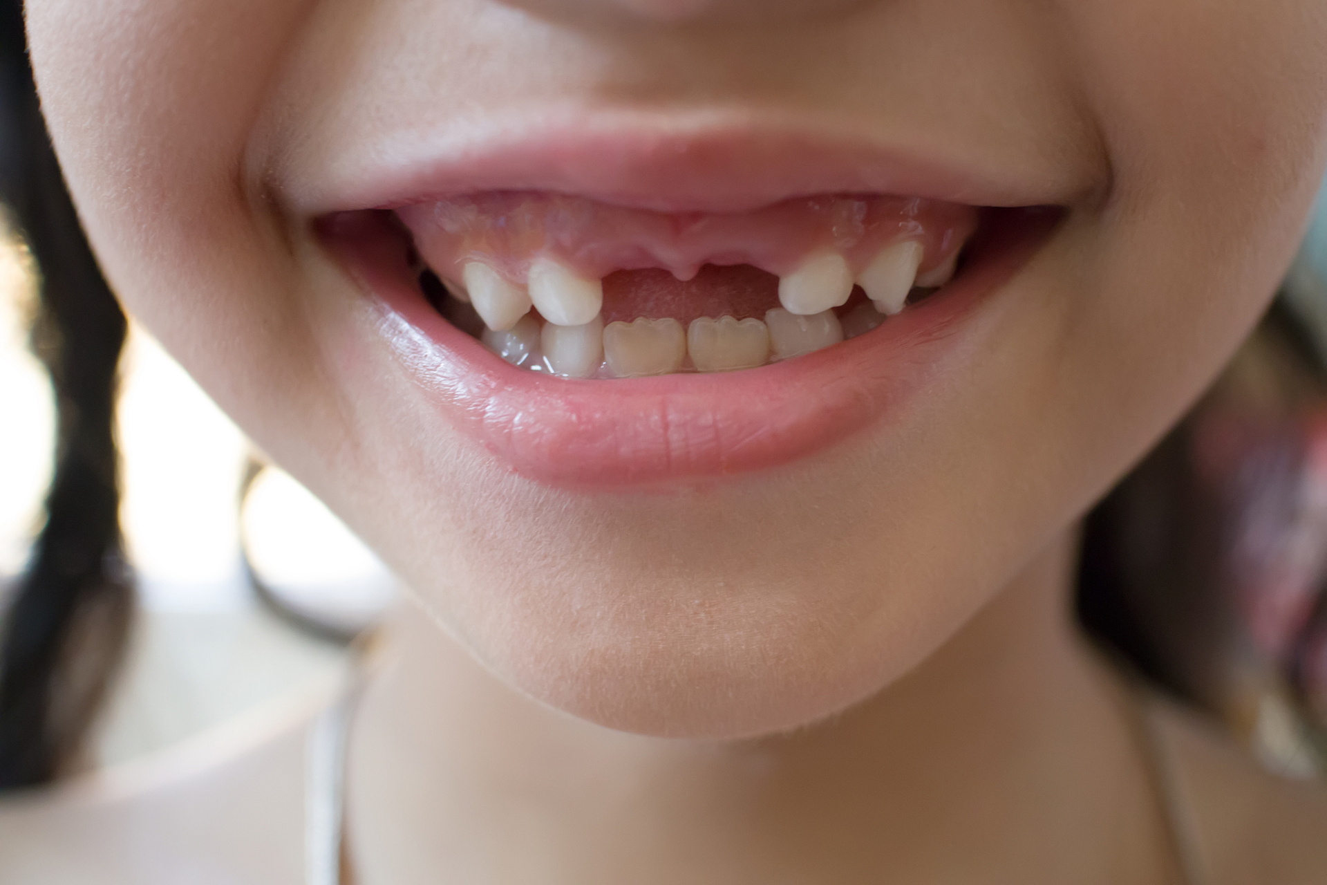 乳牙萌出的顺序通常是下颌先于上颌,由前向后,一般在3岁前出齐,13个