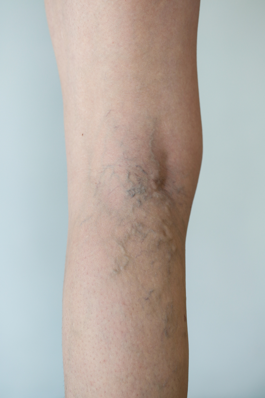 "再过个十多年,如果你等到70岁,静脉曲张拖成老烂腿会让你更受罪呀!" 