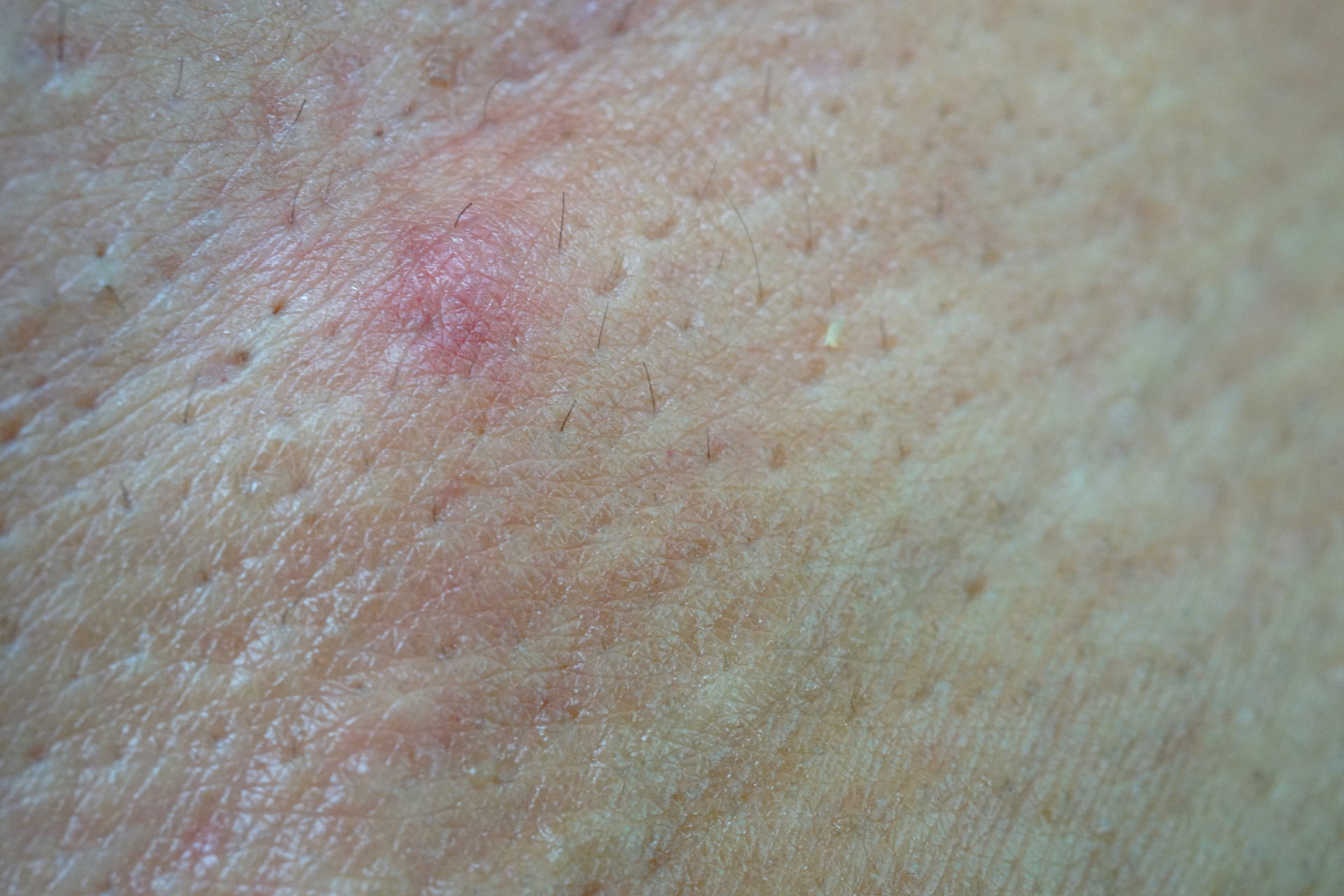 冠状沟长了一圈小米粒可能是患有珍珠状阴茎丘疹,湿疹,龟头炎等引起