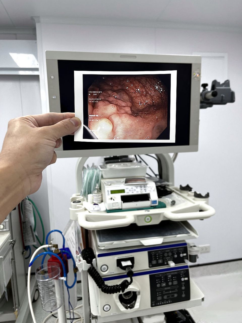 纤维,出血少,降低了并发症发生的概率,但是内窥镜腋路隆胸术对医生