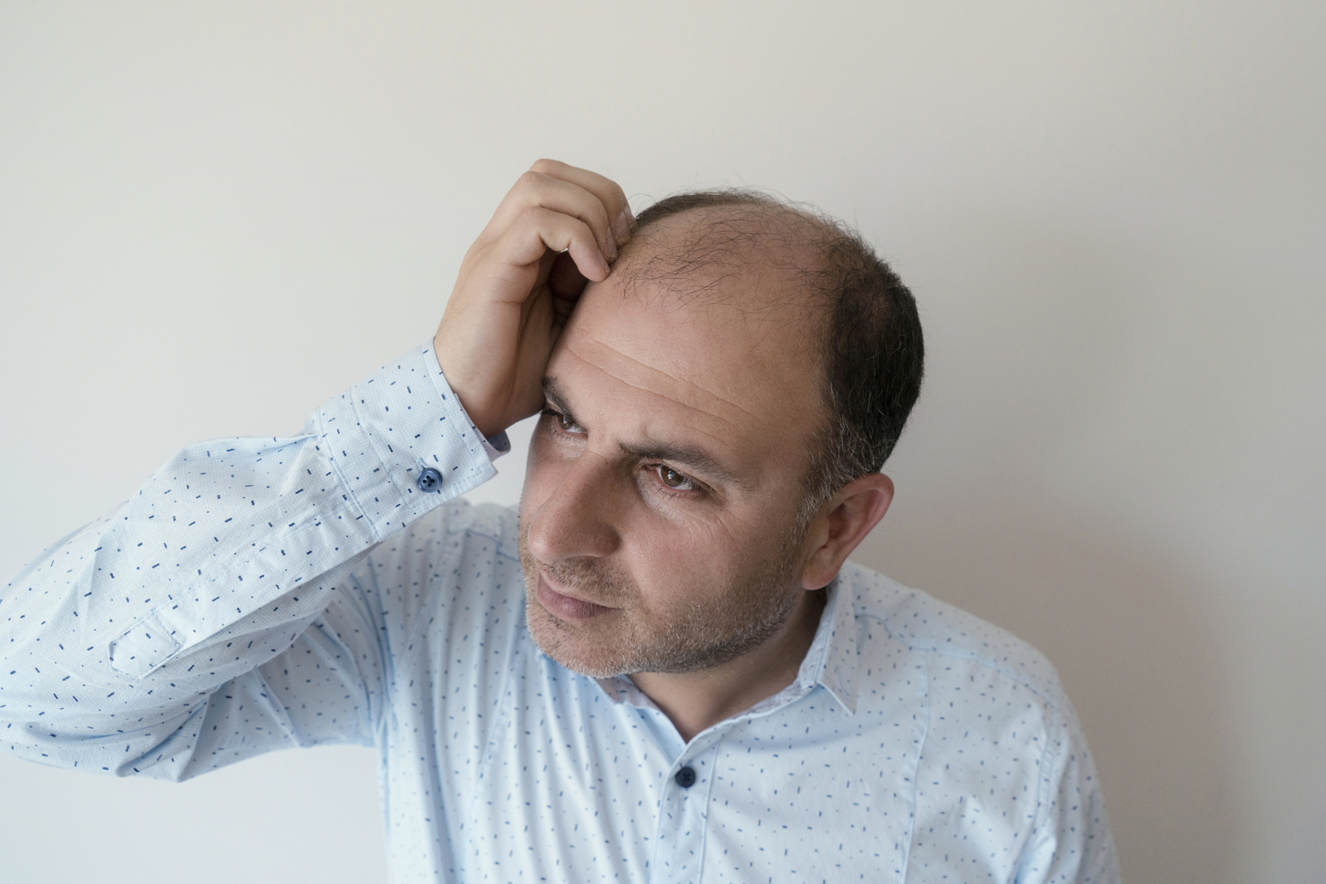 男性脱发 男性脱发(雄性型脱发)是一种常见的头发稀疏或秃顶的现象