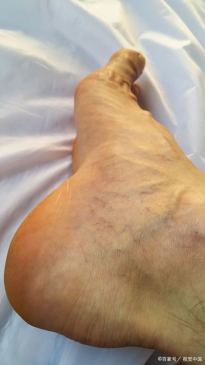 血栓性外痔的中医治疗方法