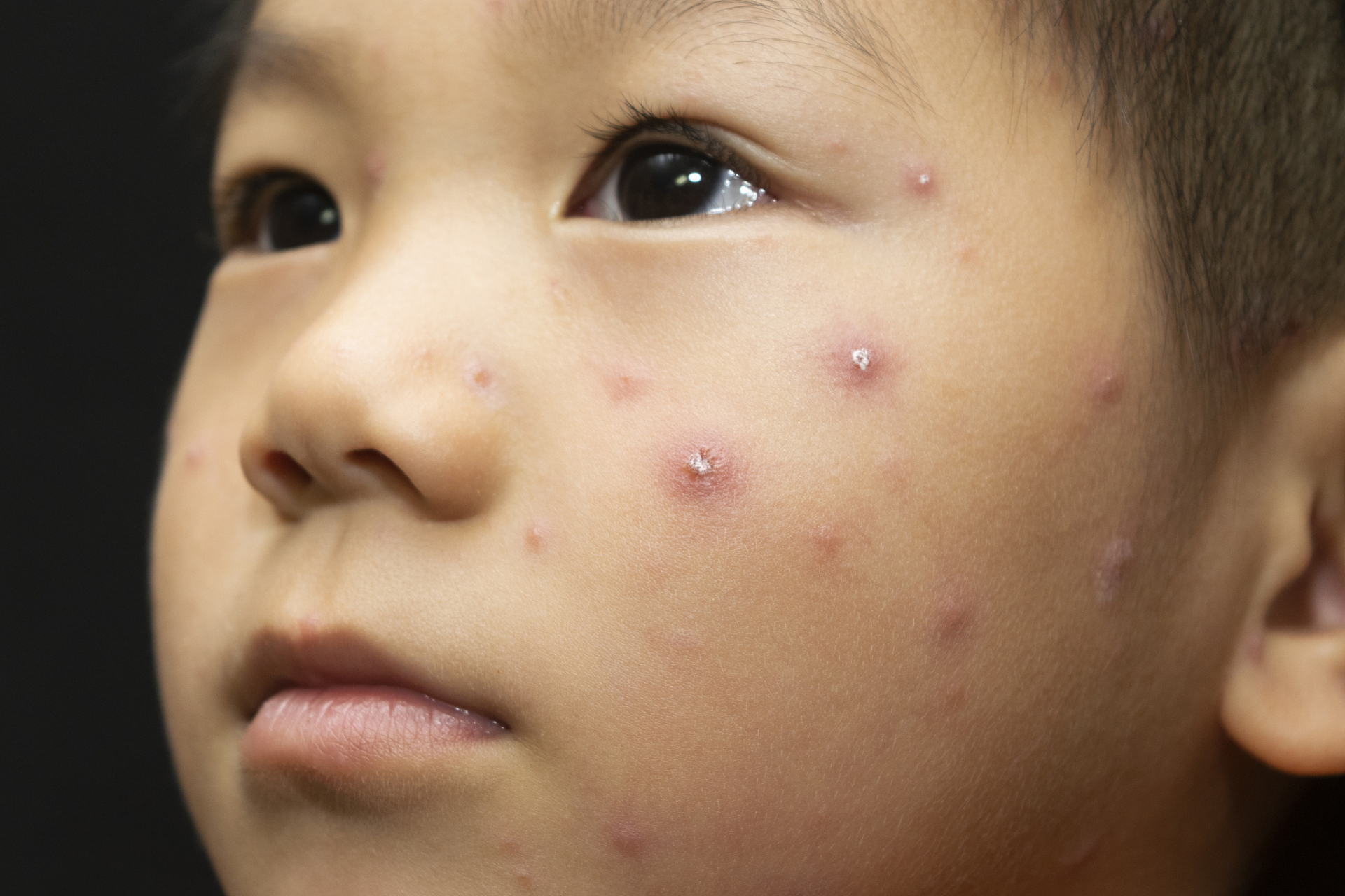 儿童水痘早期图片