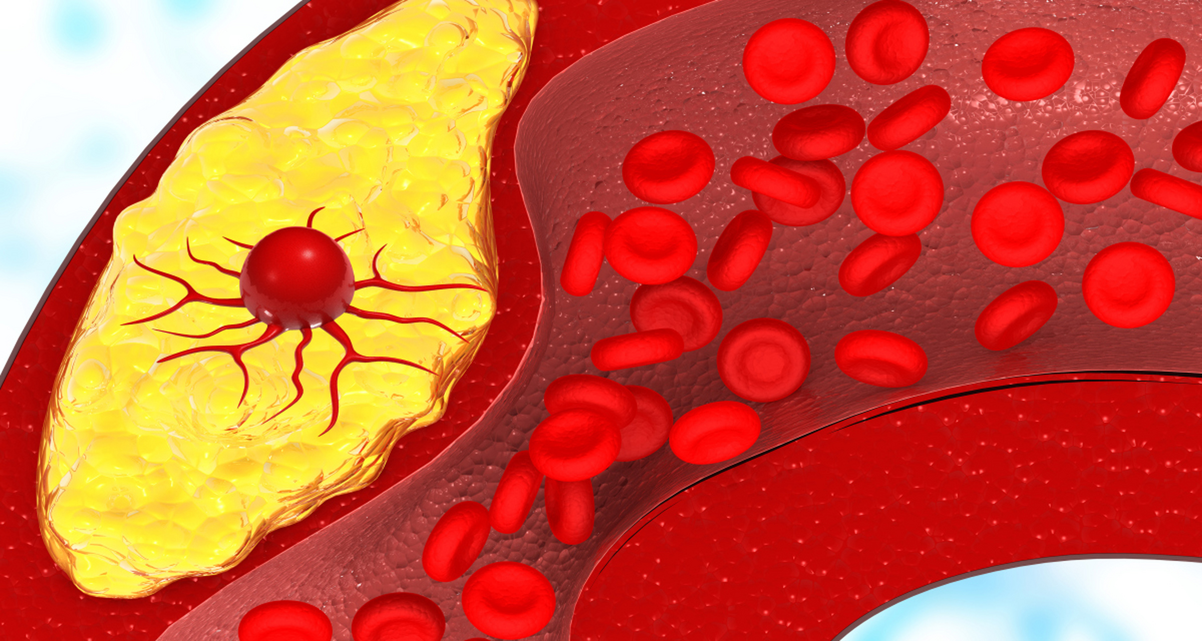 看腿如果没有4个迹象,说明血管非常通畅 1,皮肤皮质紧 高血脂会有一个