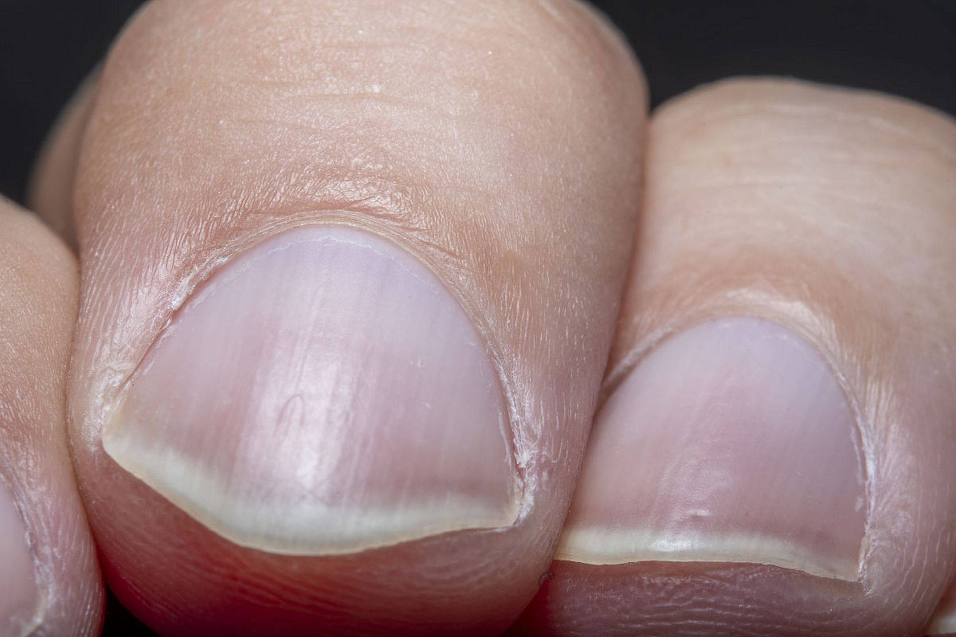 指甲竖纹# #营养不良# #属你最美# #恒星计划# #用营养守护健康