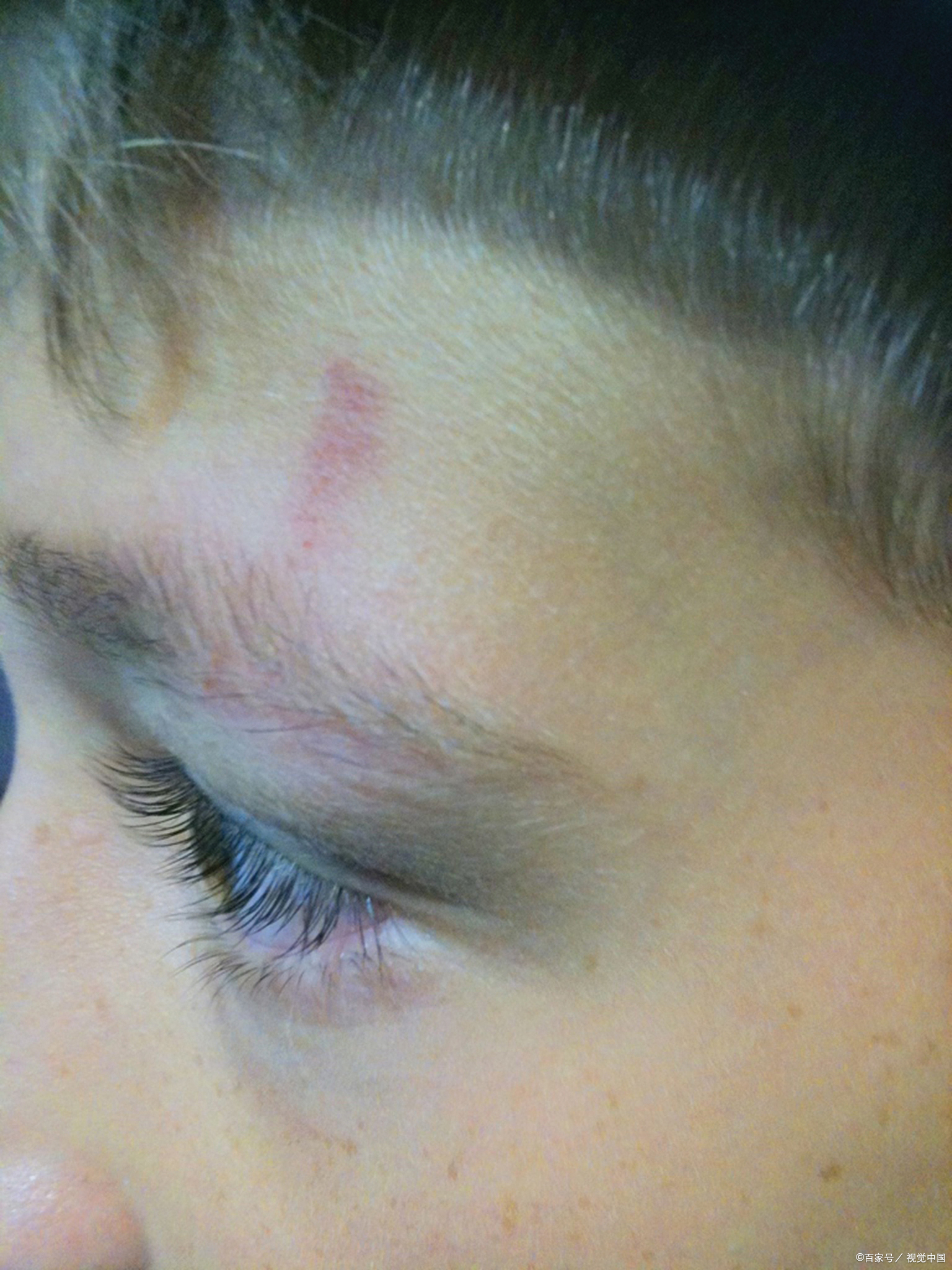 宝宝磕伤眼角需警惕,眼眶外缘外部伤一般不影响眼球,但宝宝受伤迅速