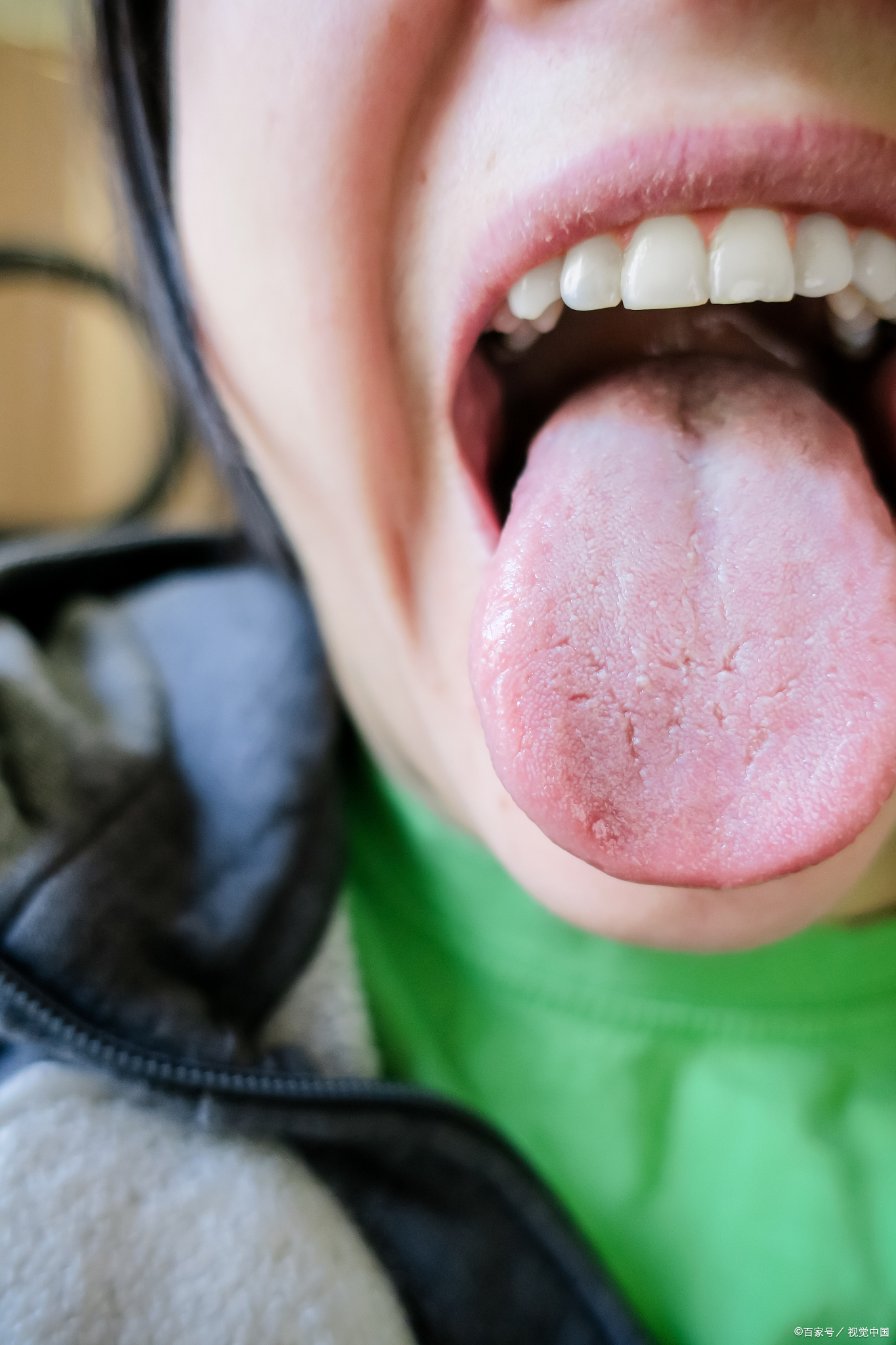 舌苔:口腔健康的晴雨表 舌苔,这层覆盖在舌头表面,细腻或粗糙的薄膜