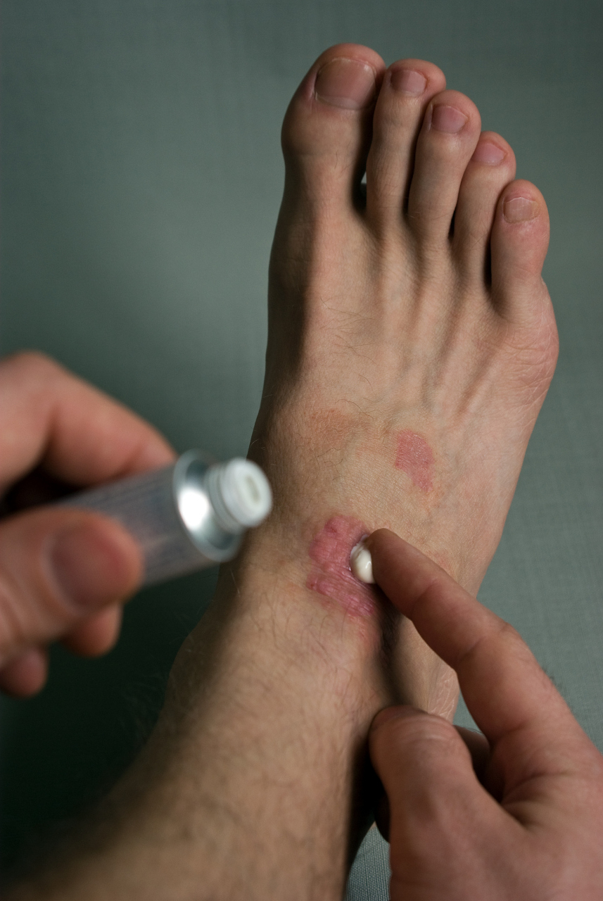 特应性皮炎又称异位性皮炎,遗传过敏性皮炎,是一种慢性复发性,瘙痒