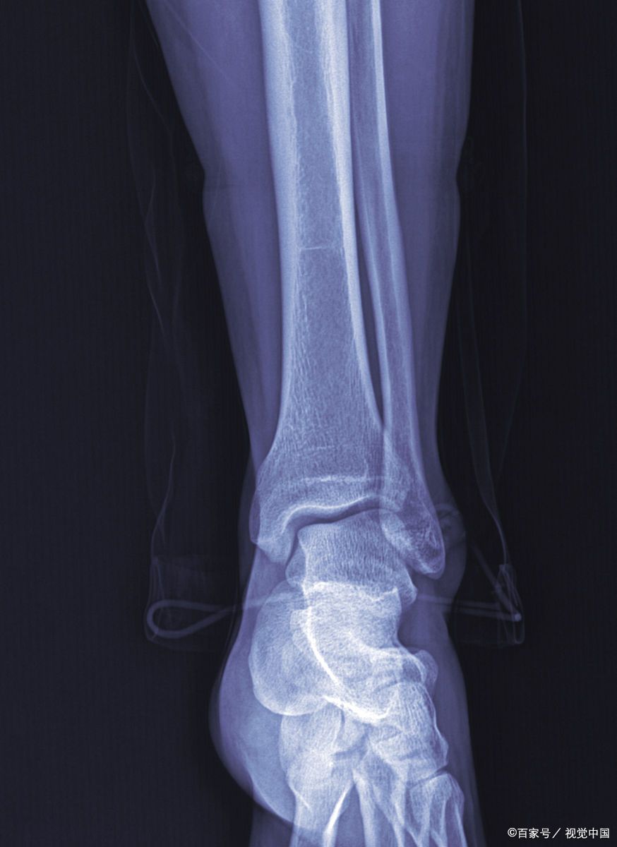 科普与处理建议指南 脚踝骨骨折是一种常见的损伤,通常由意外扭伤