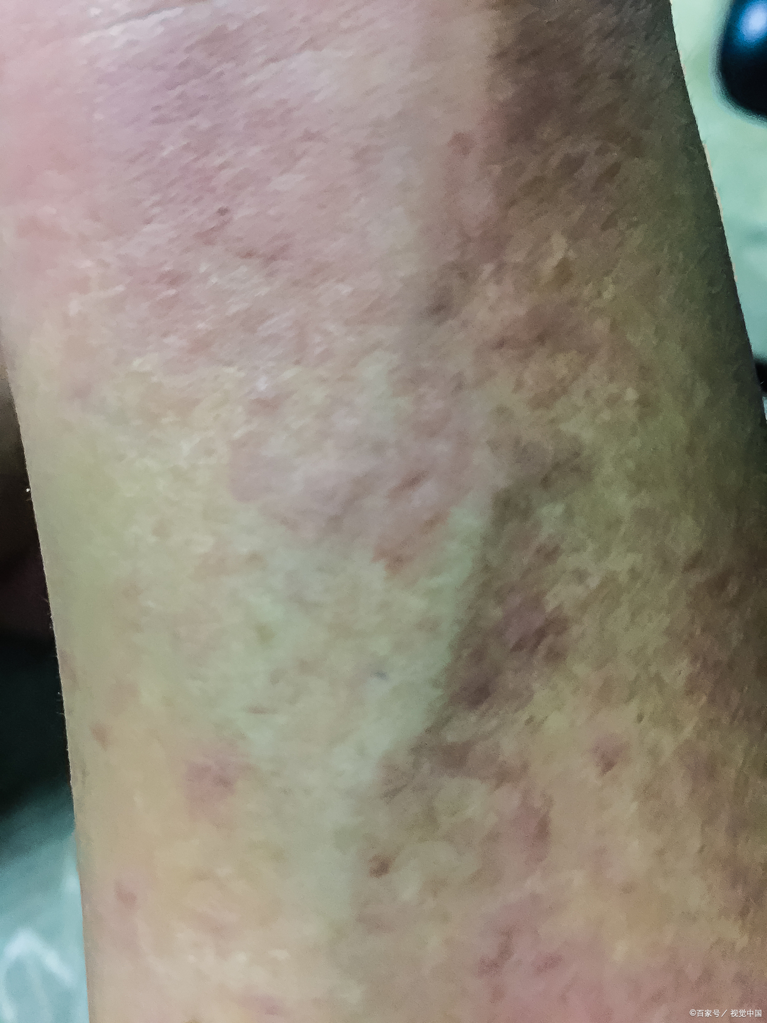 穿无袖衣服时,腋下皮肤突然出现红疹或发黑总让人担心