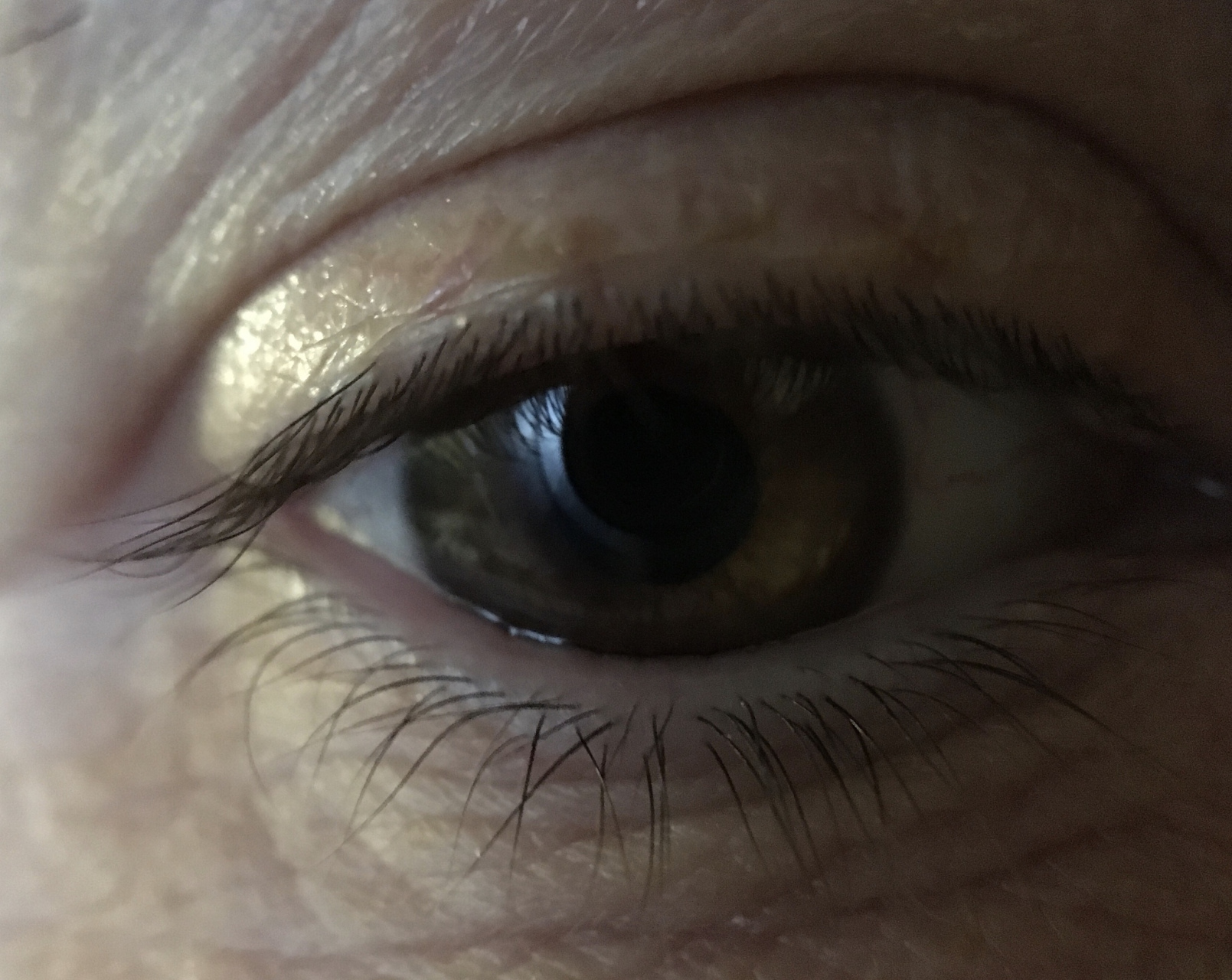 眼皮上的黄斑可能是脂质沉着斑,也可能是黄色瘤,两者的处理方法有所不