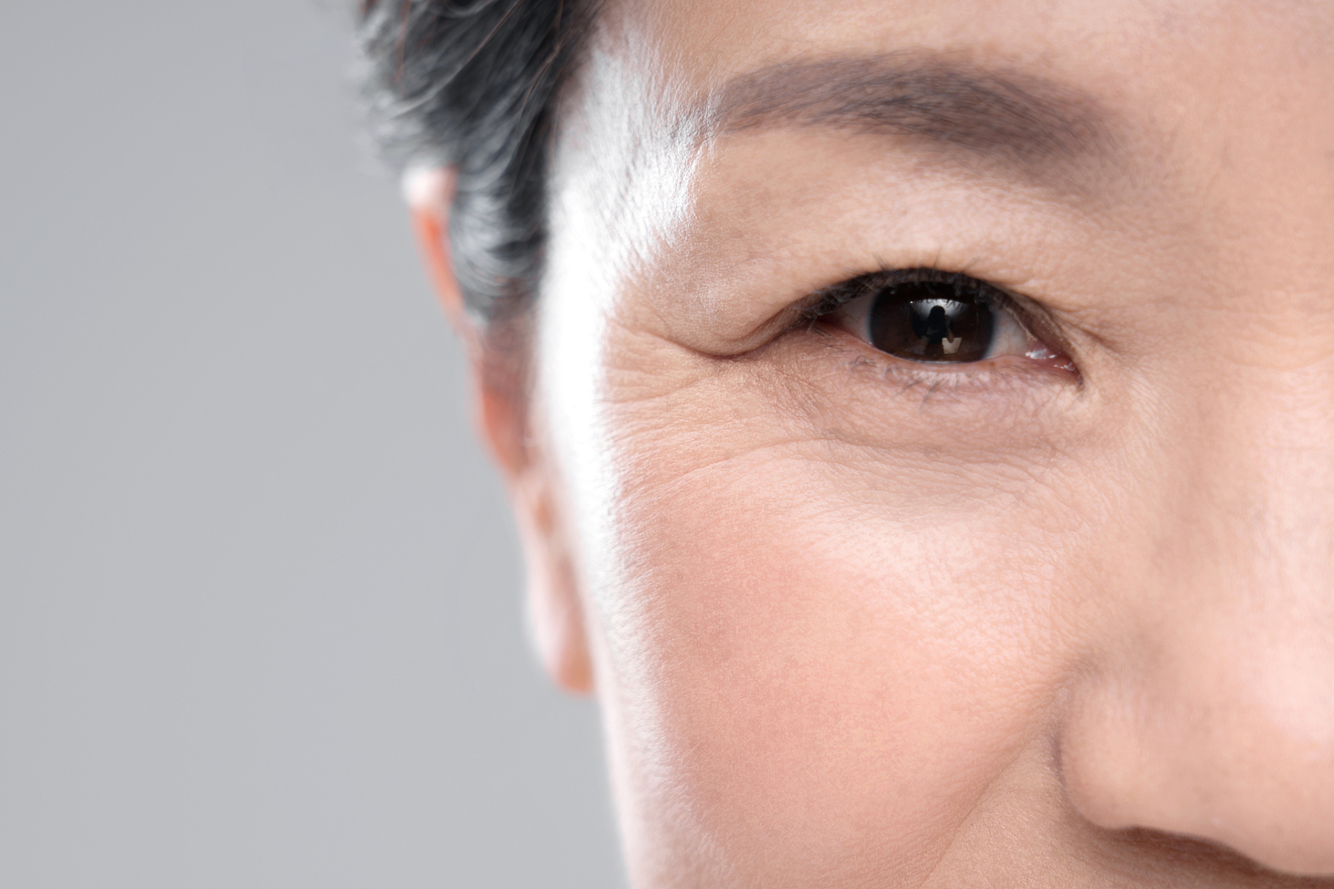 抬头纹,眉间纹:假性皱纹肉毒素注射为主,真性皱纹联合玻尿酸填充