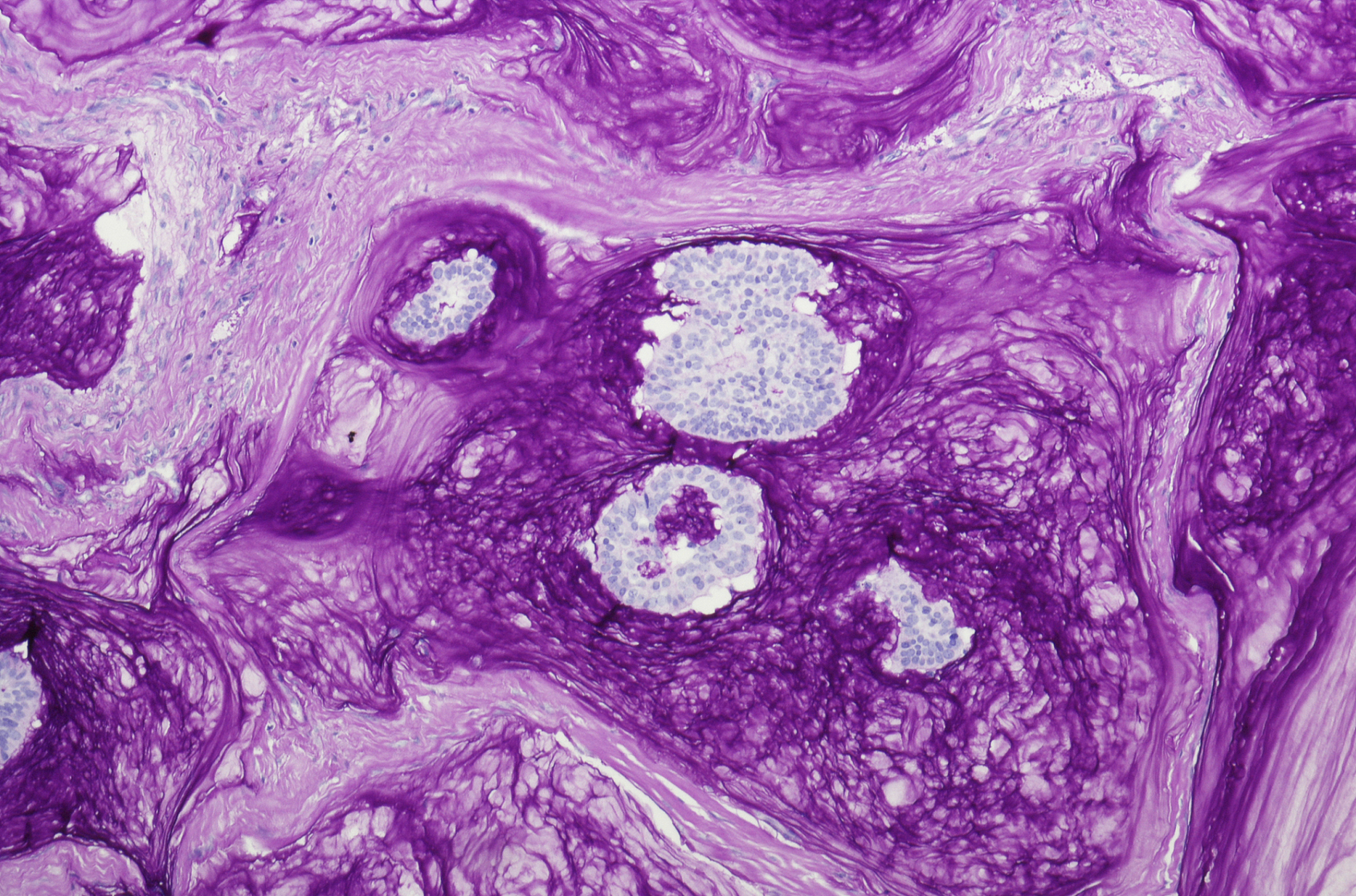 早期非浸润性:原位癌属于癌症的早期阶段,尚未突破基底膜,因此没有