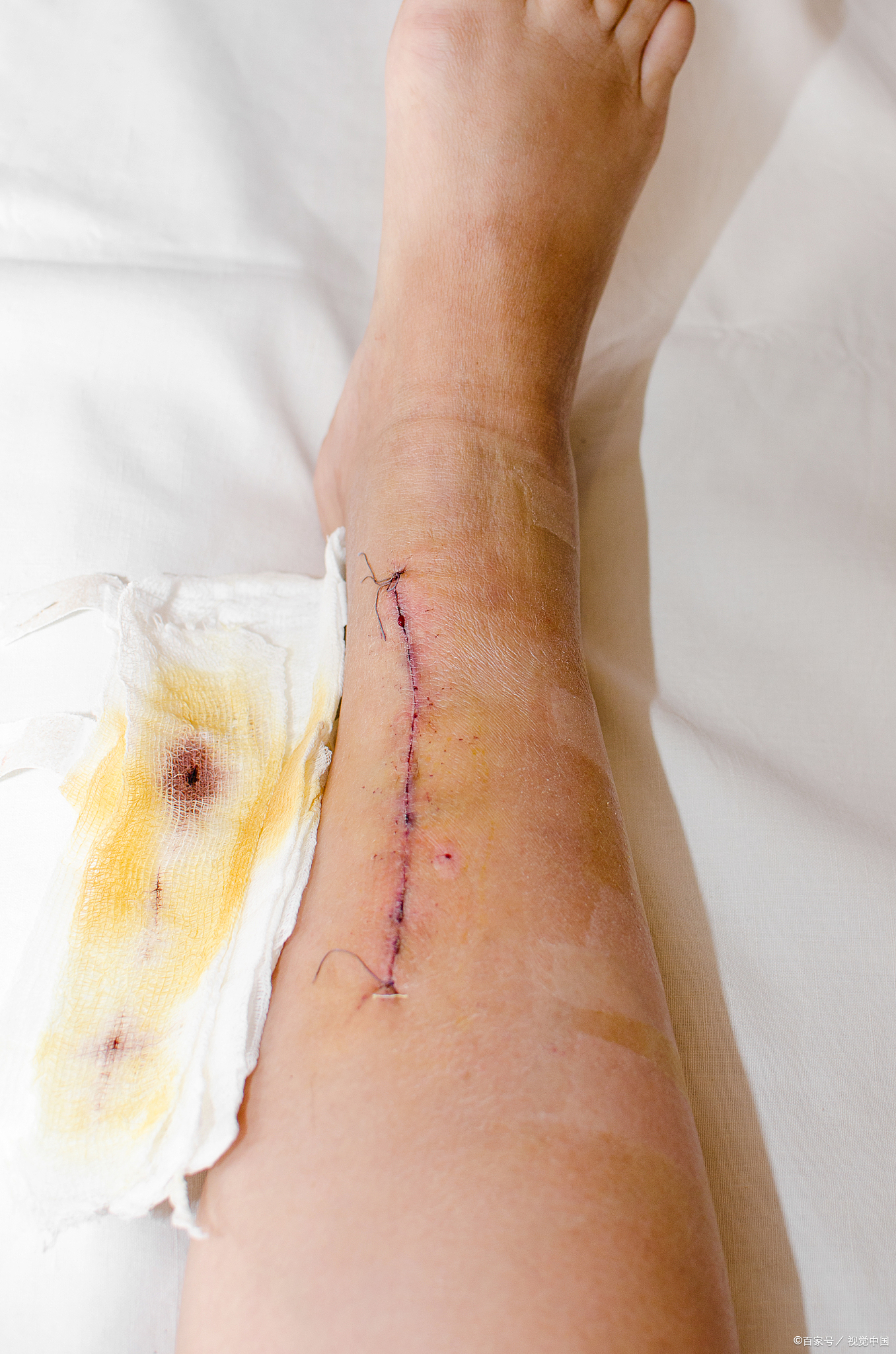 膝盖摔伤后的饮食禁忌有 男 