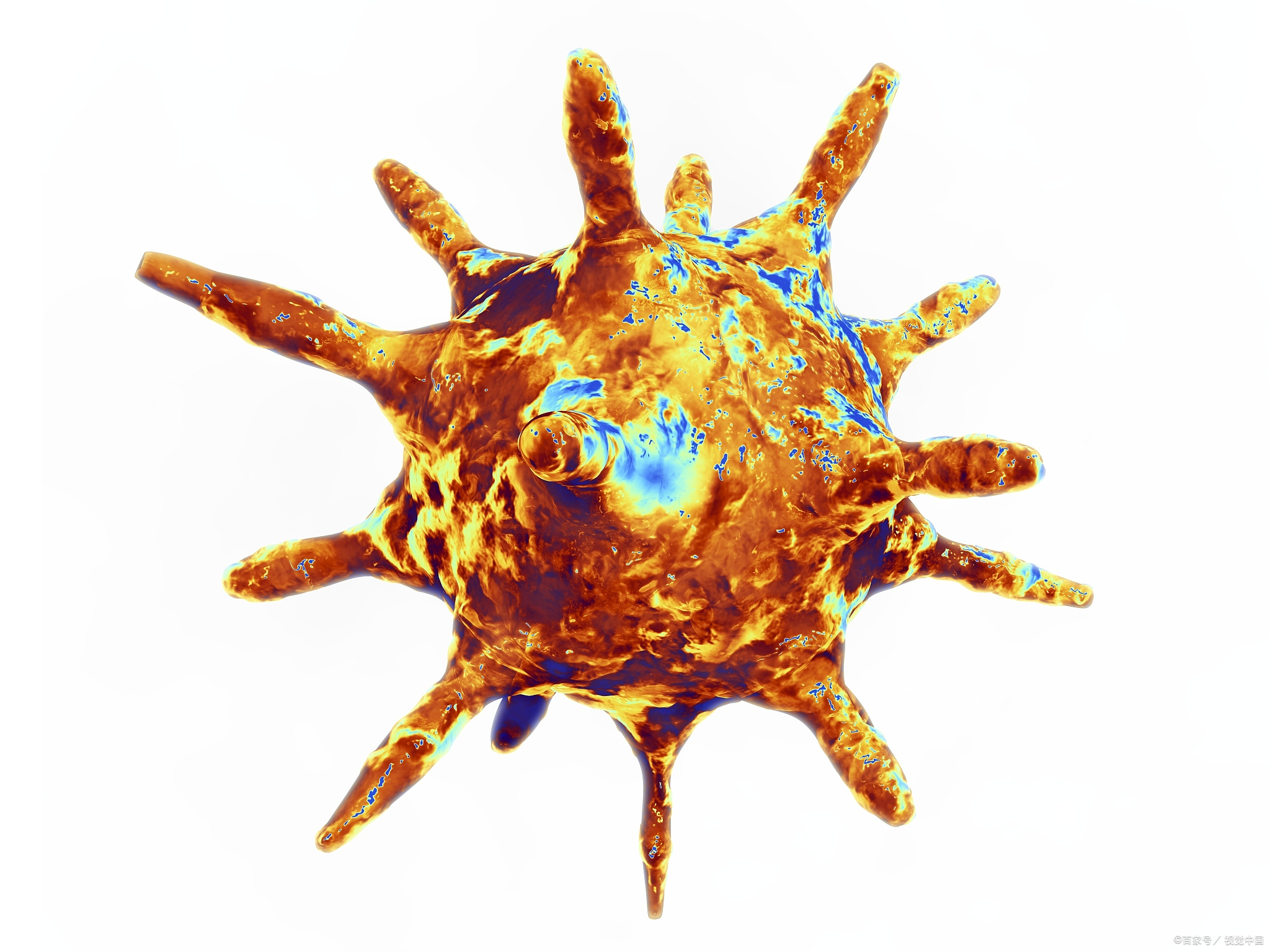 炎,眼部卫生差及免疫力下降等因素引发,是眼睑腺体的急性化脓性炎症