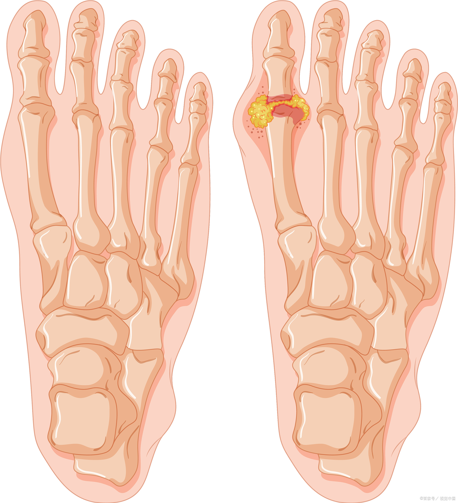 痛风尿酸盐结晶如何检查?一文带你全面了解!