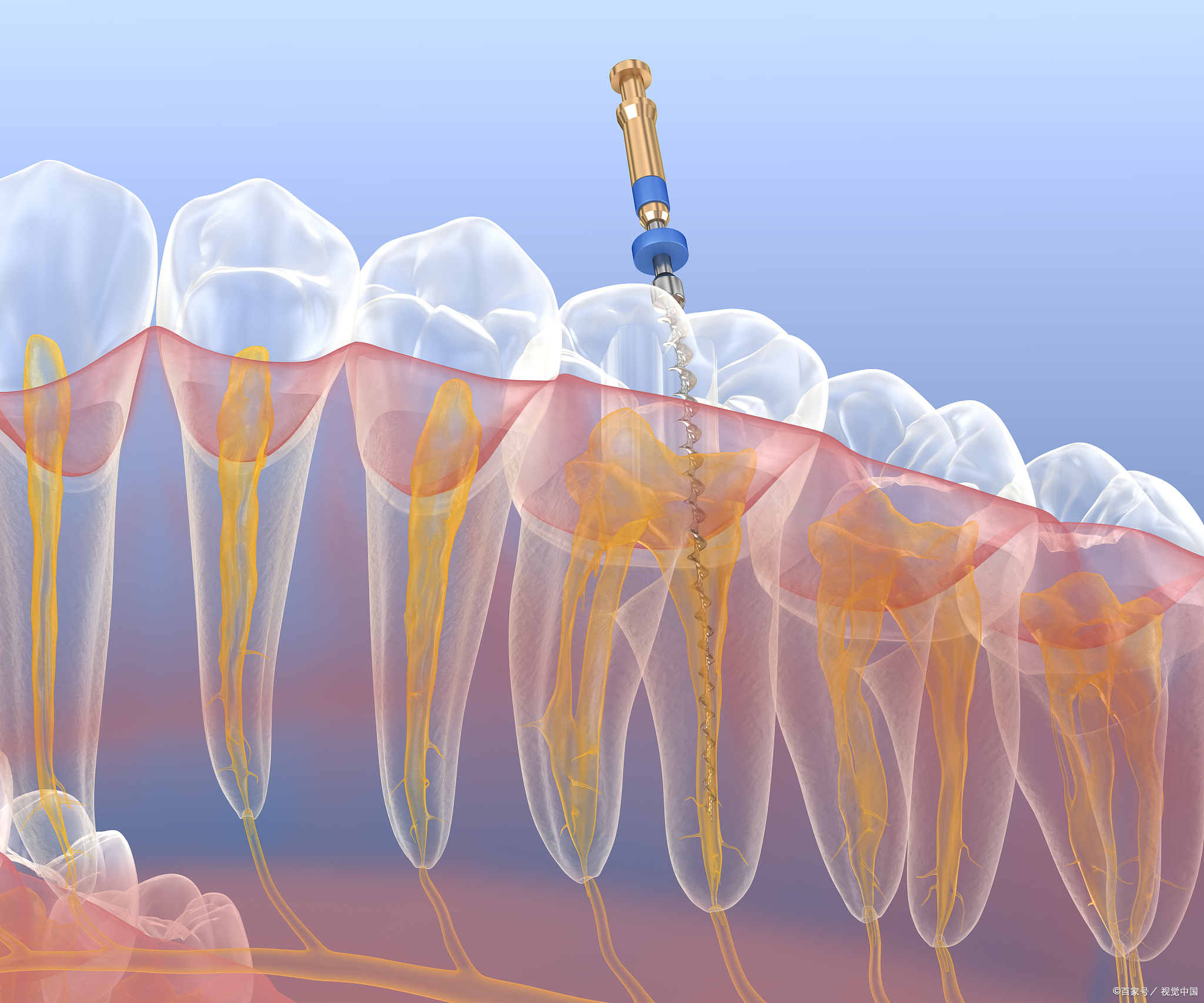 哎呀,终于决定要去延吉做根管治疗了?