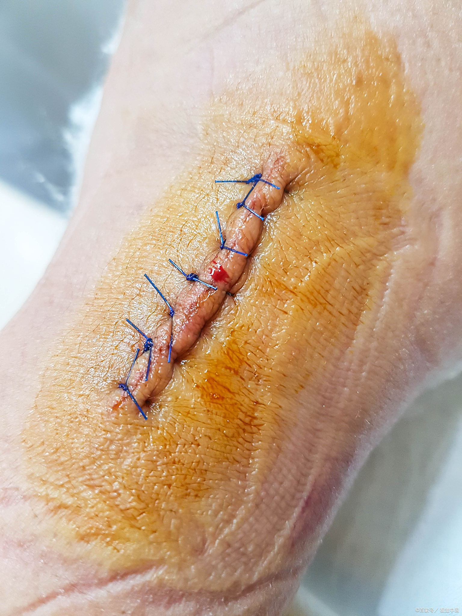 跟骨手术伤口坏死症状表现