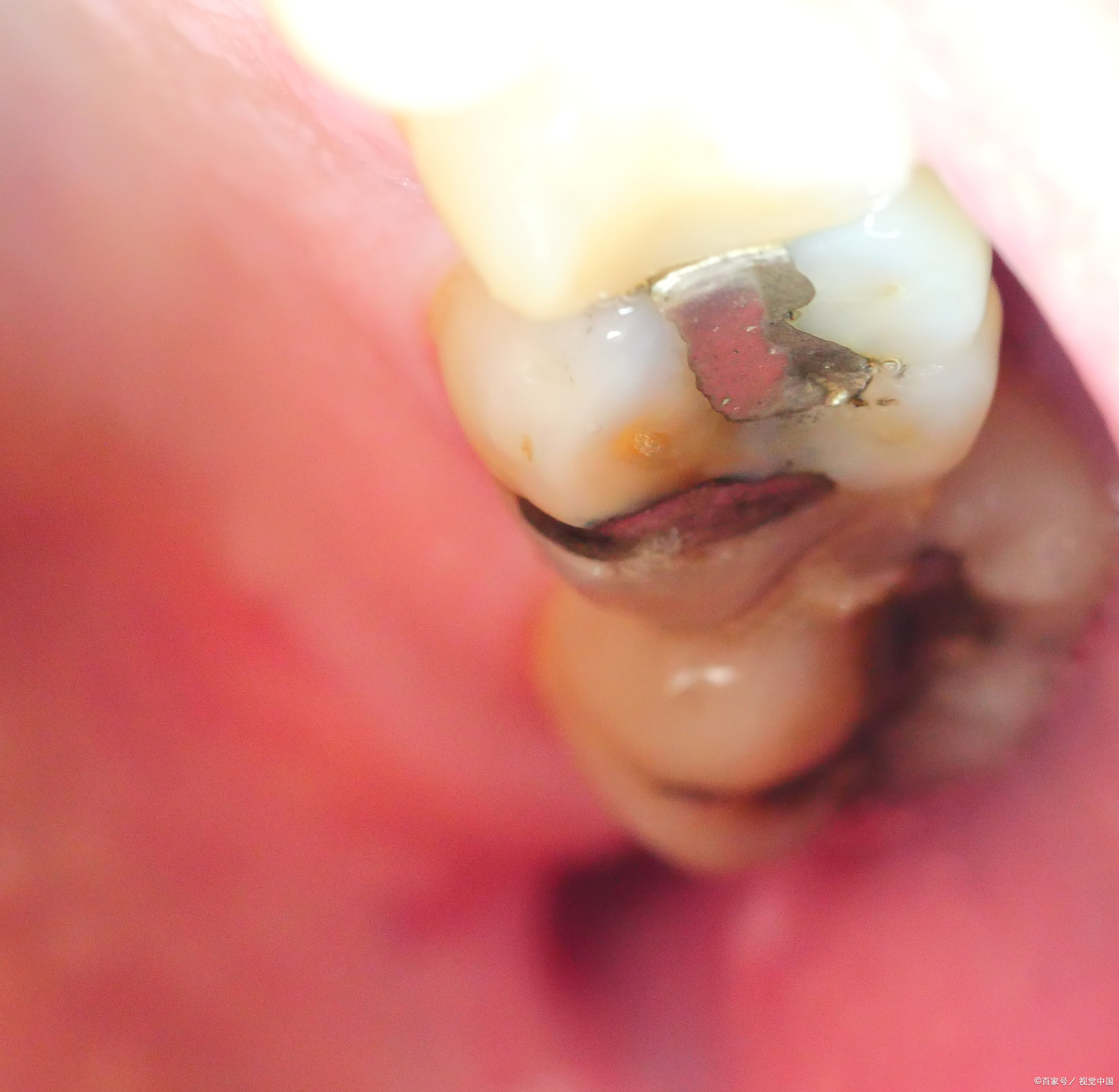 当我们发现牙齿上出现了一个小黑点,不疼也不痒,于是我们可能会选择