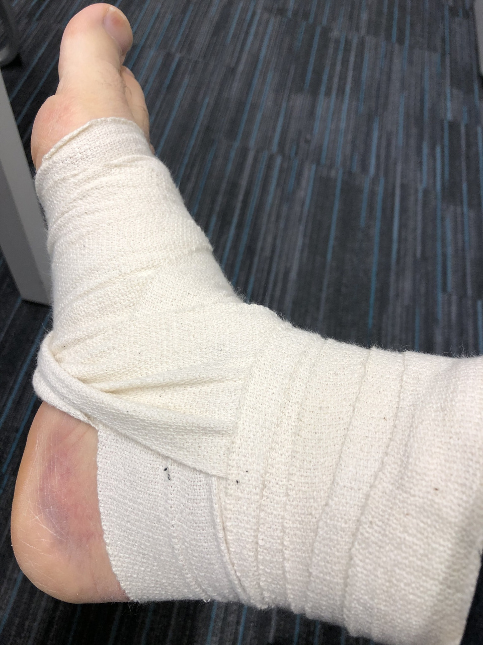 脚踝骨折后多久可以恢复正常  脚踝骨折的恢复时间因人而异,一般需要6