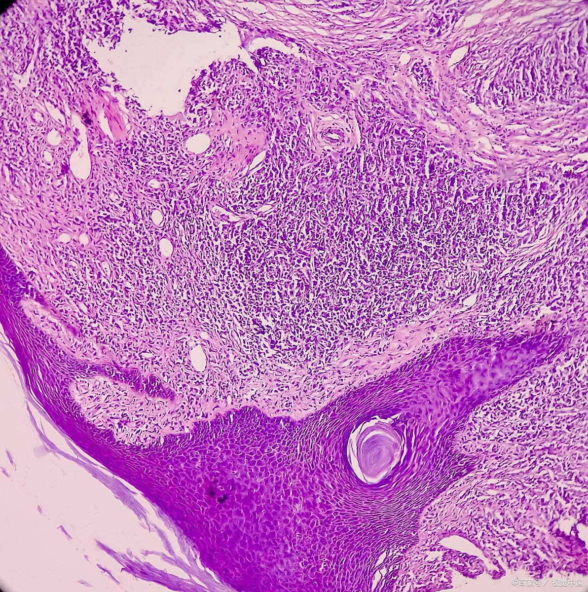 女性腹壁纤维瘤:真的严重吗?