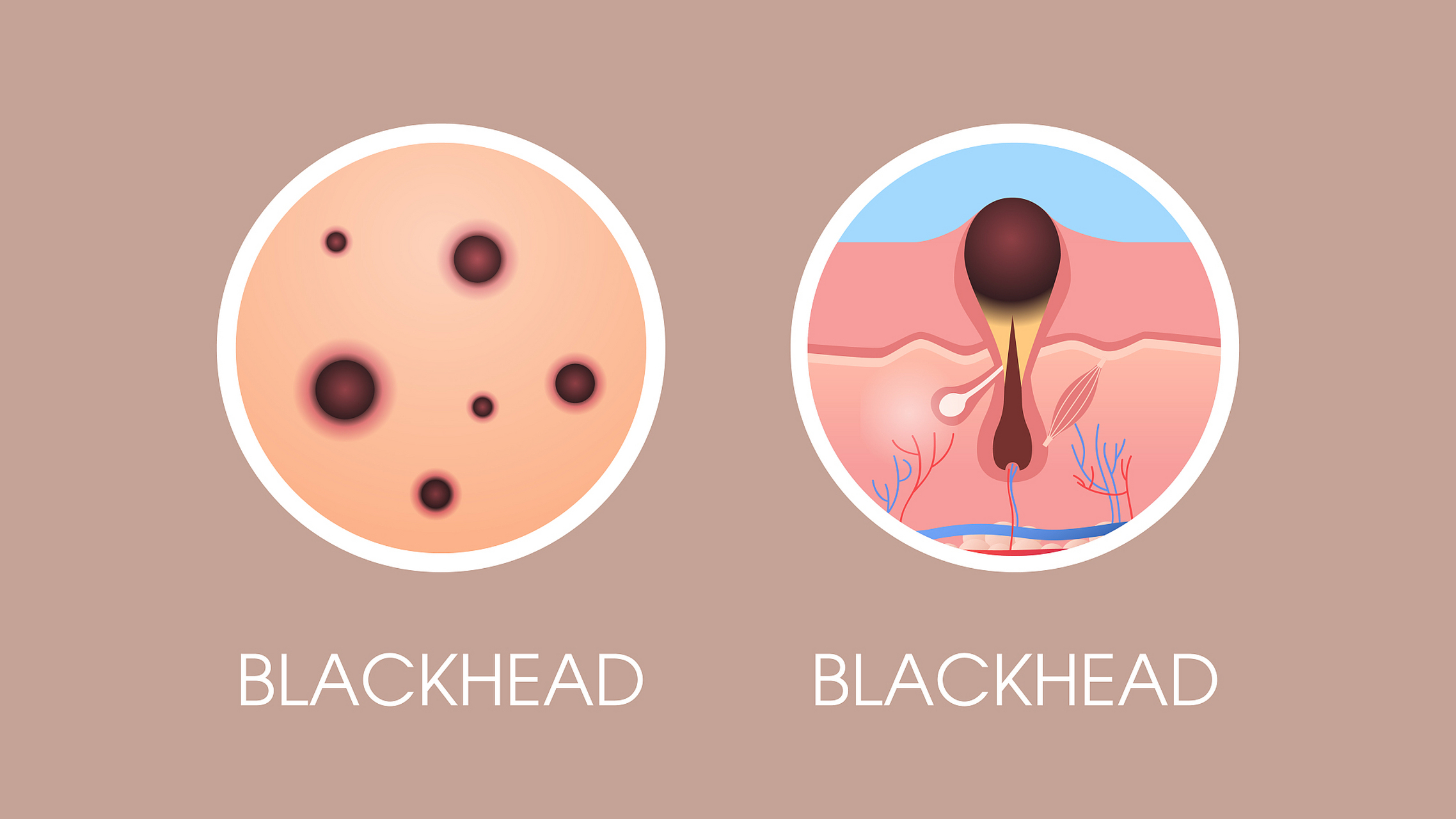 毛孔很容易被堵塞 黑头又开始困扰着我了!