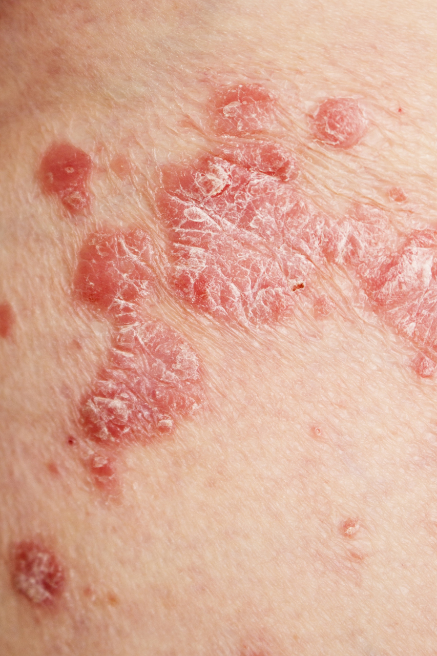 本文将简单介绍几种常见的皮肤病分类.