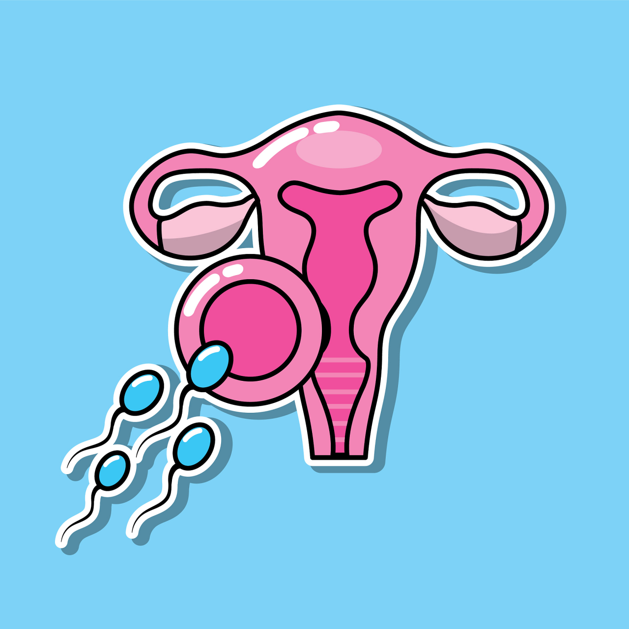 输卵管结扎术通过切断,结扎,电凝,钳夹,环套输卵管,使精子与卵子材苘