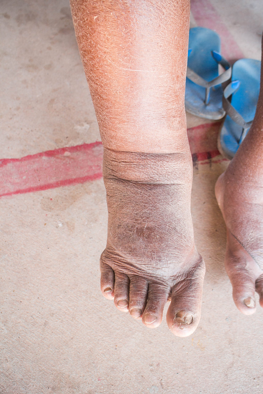 糖尿病肾病早期症状,该如何发现? 糖尿病肾病是尿毒症最常见原因之一.