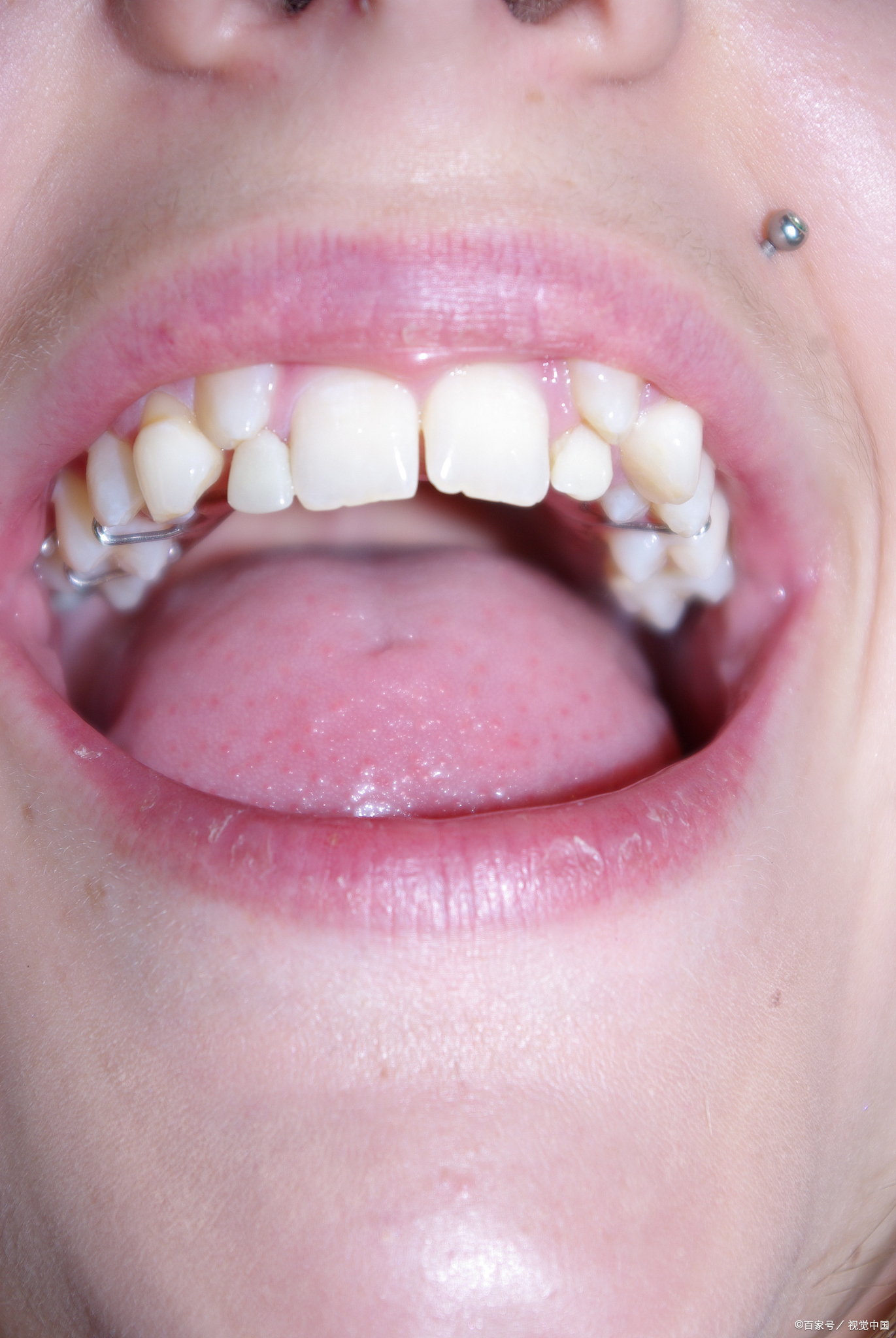 民间叫它"双排牙""连体牙",其实在牙齿发育期