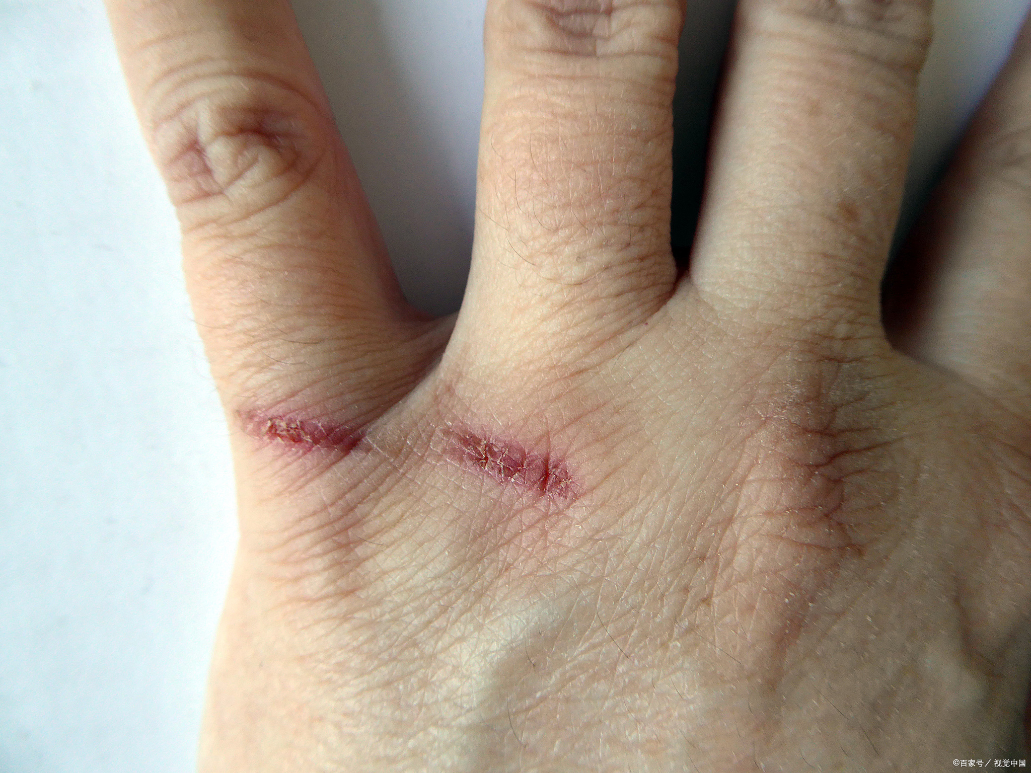 伤口在愈合的过程中,常常会出现一种让人忍不住想去挠的痒痒的感觉,这