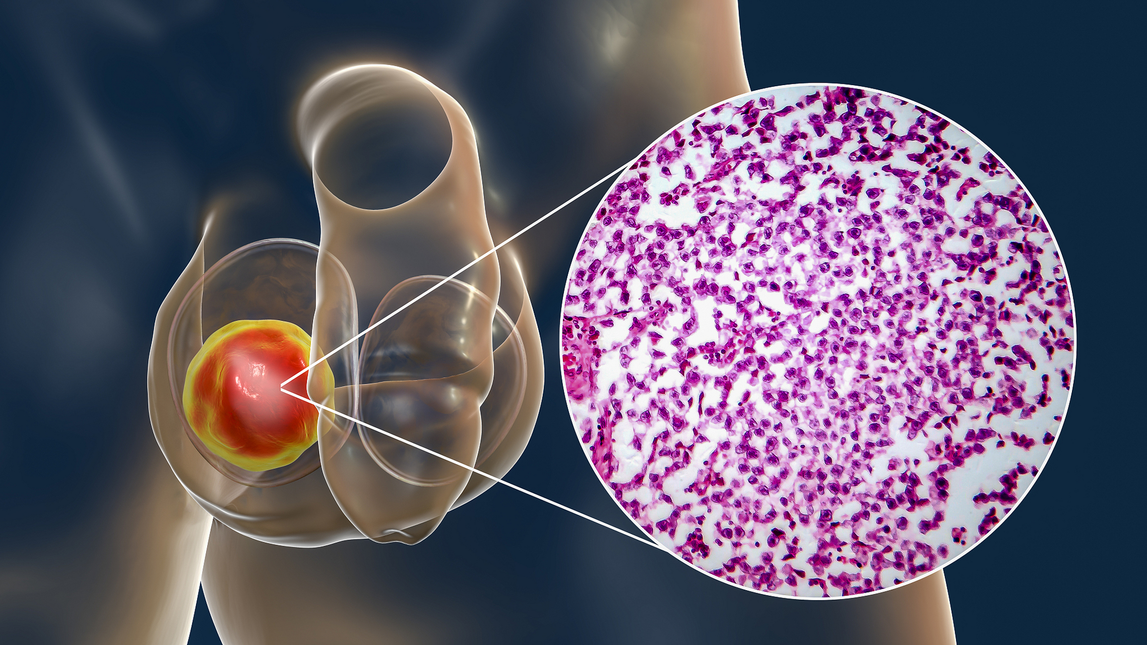 预防睾丸癌的方法包括:定期自我检查睾丸,避免吸烟和饮酒,保持健康的