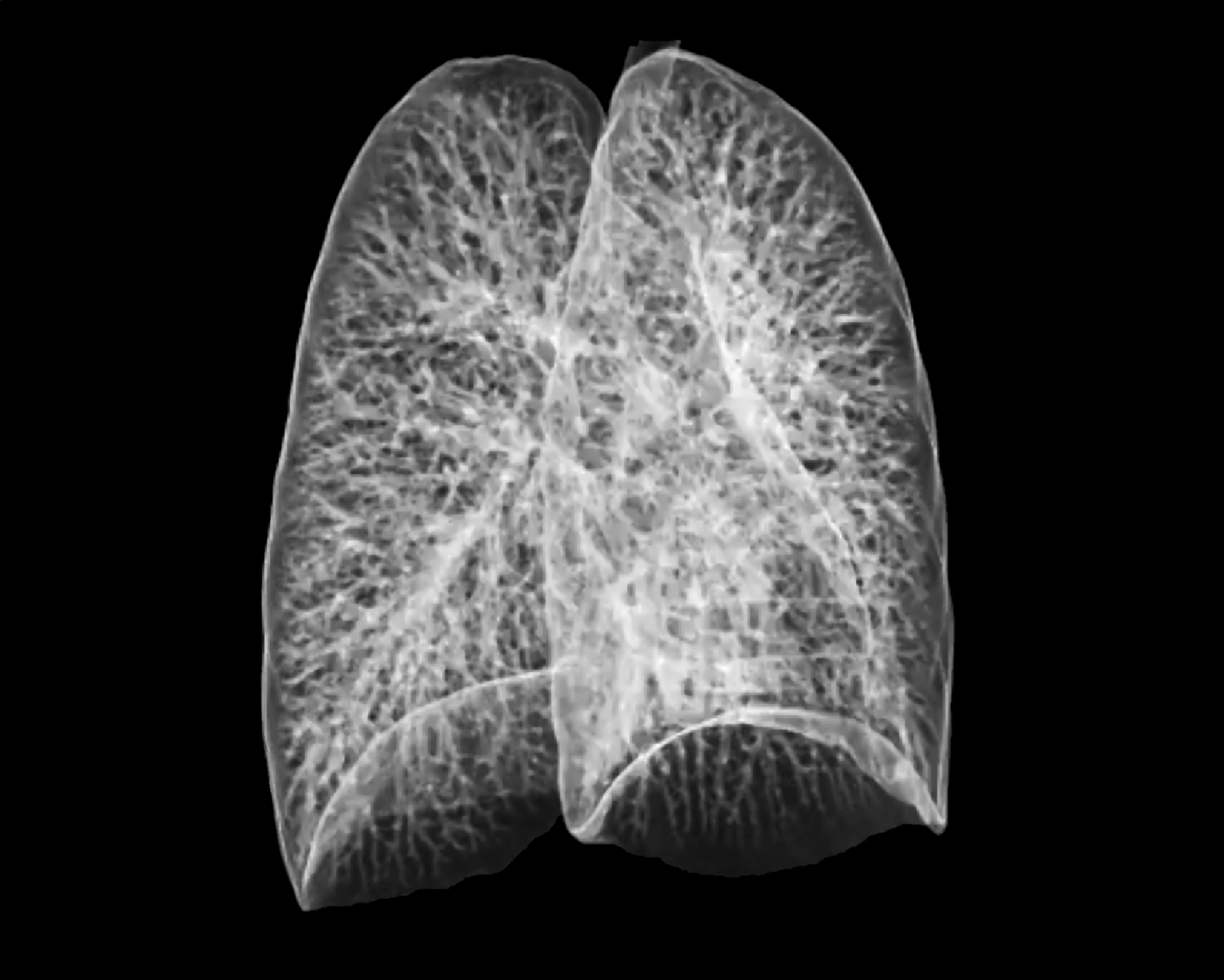 肺纤维化能治愈吗图片